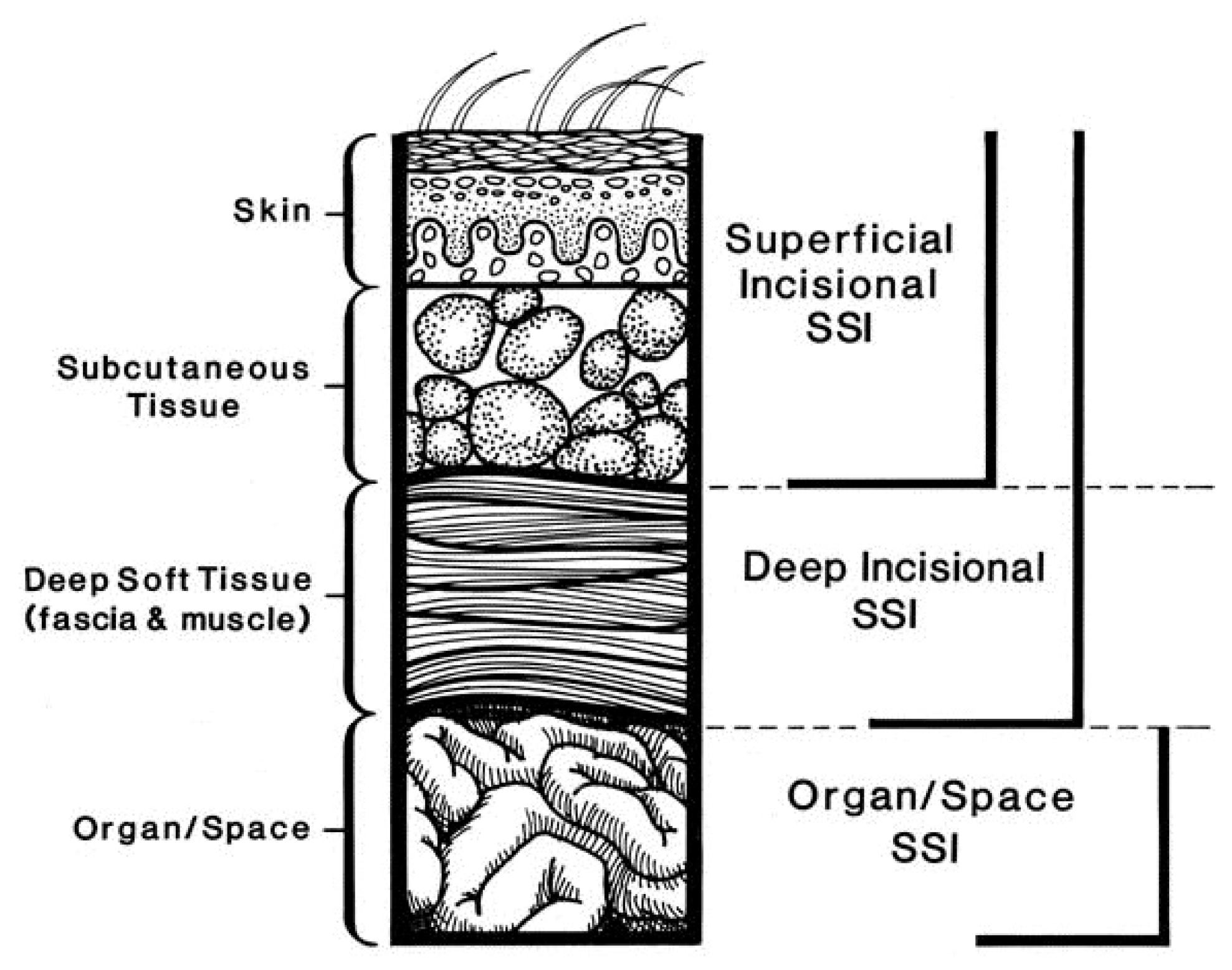 Infection journal. NHSN CDC.