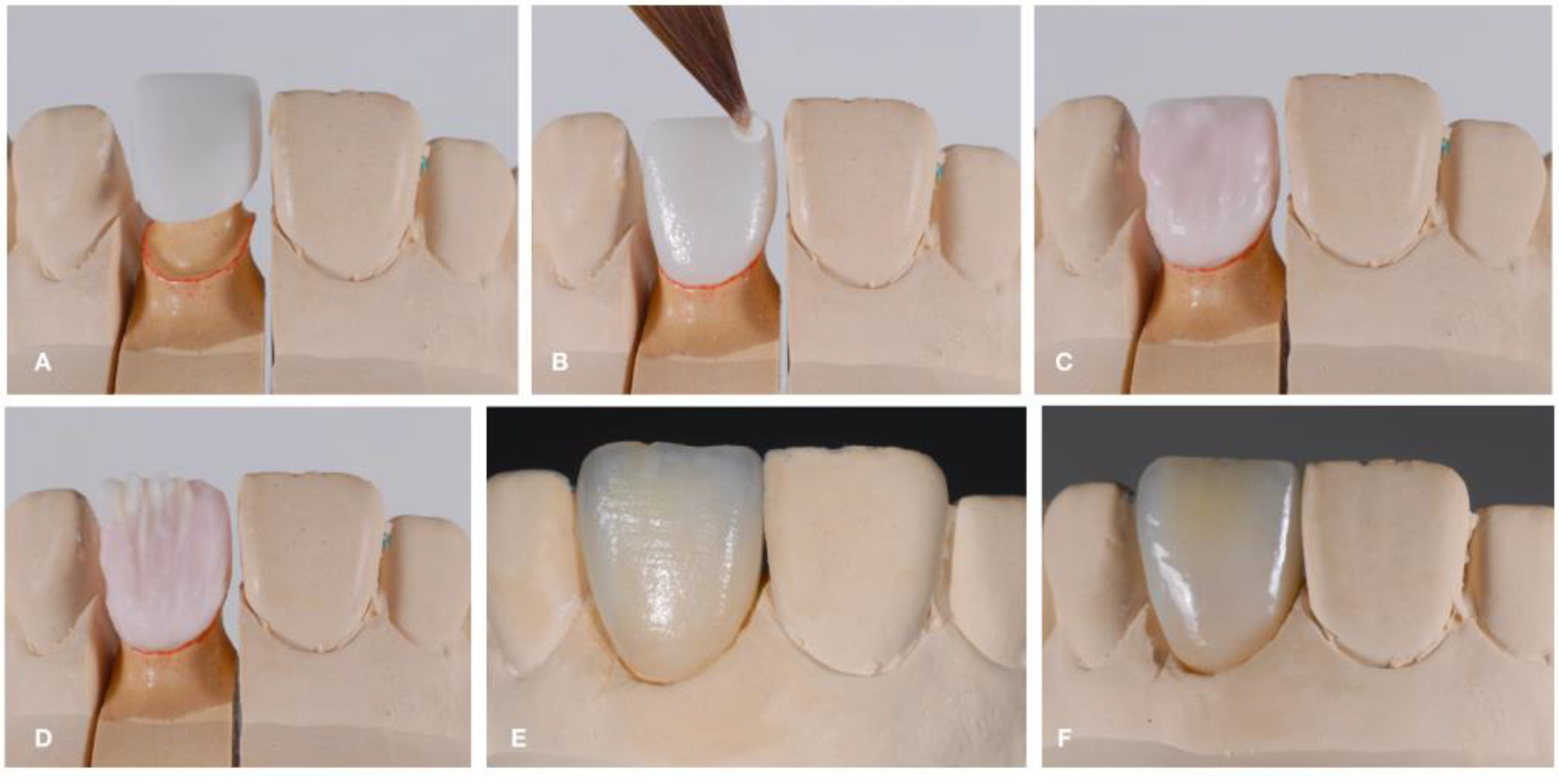 Coatings | Free Full-Text | Dental Ceramics: Fabrication Methods and  Aesthetic Characterization