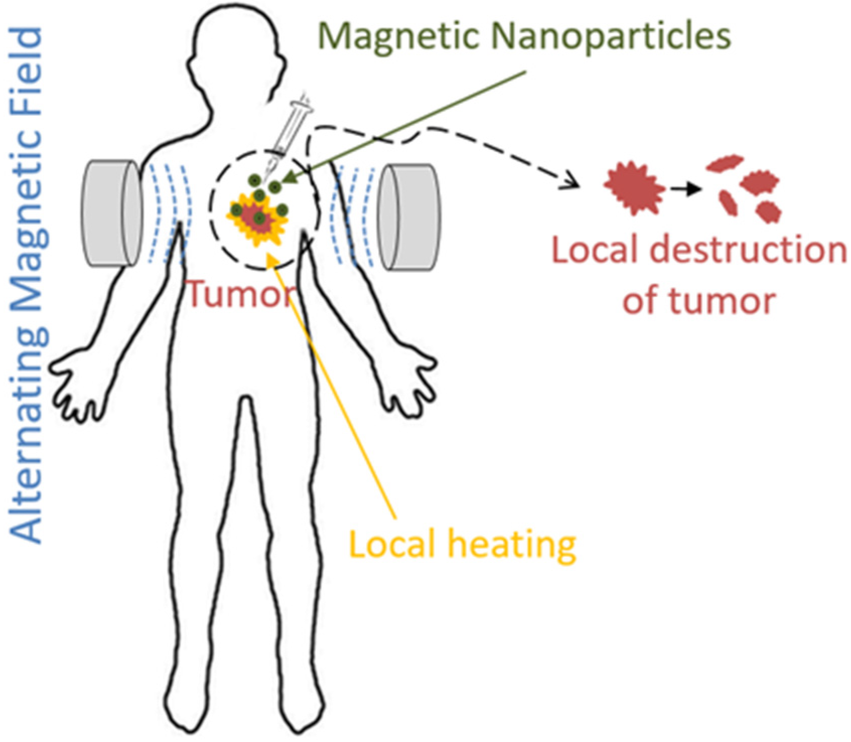 Computation | Free Full-Text | Natural Convection of Blood&ndash;Magnetic  Iron Oxide Bio-nanofluid in the Context of Hyperthermia Treatment