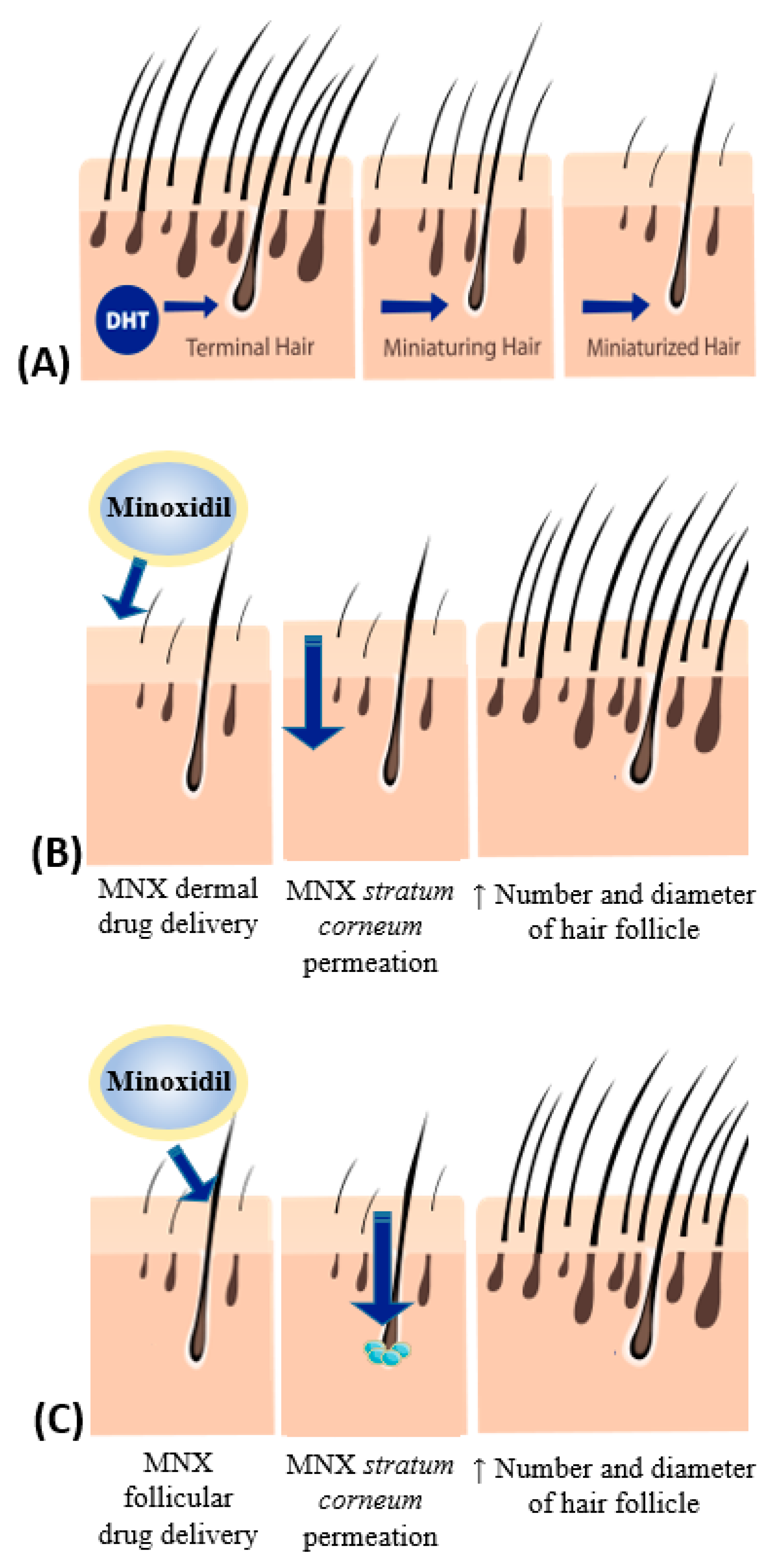 Cosmetics | Free Full-Text | Topical Minoxidil-Loaded Nanotechnology  Strategies for Alopecia