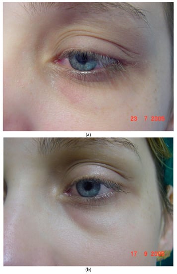Cosmetics | Free Full-Text | Periorbital Hyperpigmentation—Dark Circles  under the Eyes; Treatment Suggestions and Combining Procedures