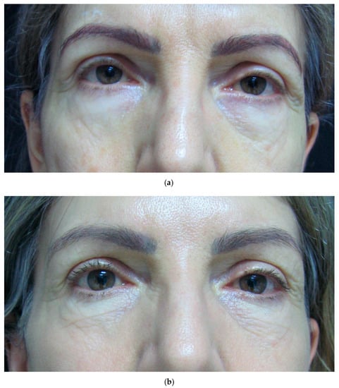 Cosmetics | Free Full-Text | Periorbital Hyperpigmentation—Dark Circles  under the Eyes; Treatment Suggestions and Combining Procedures | HTML