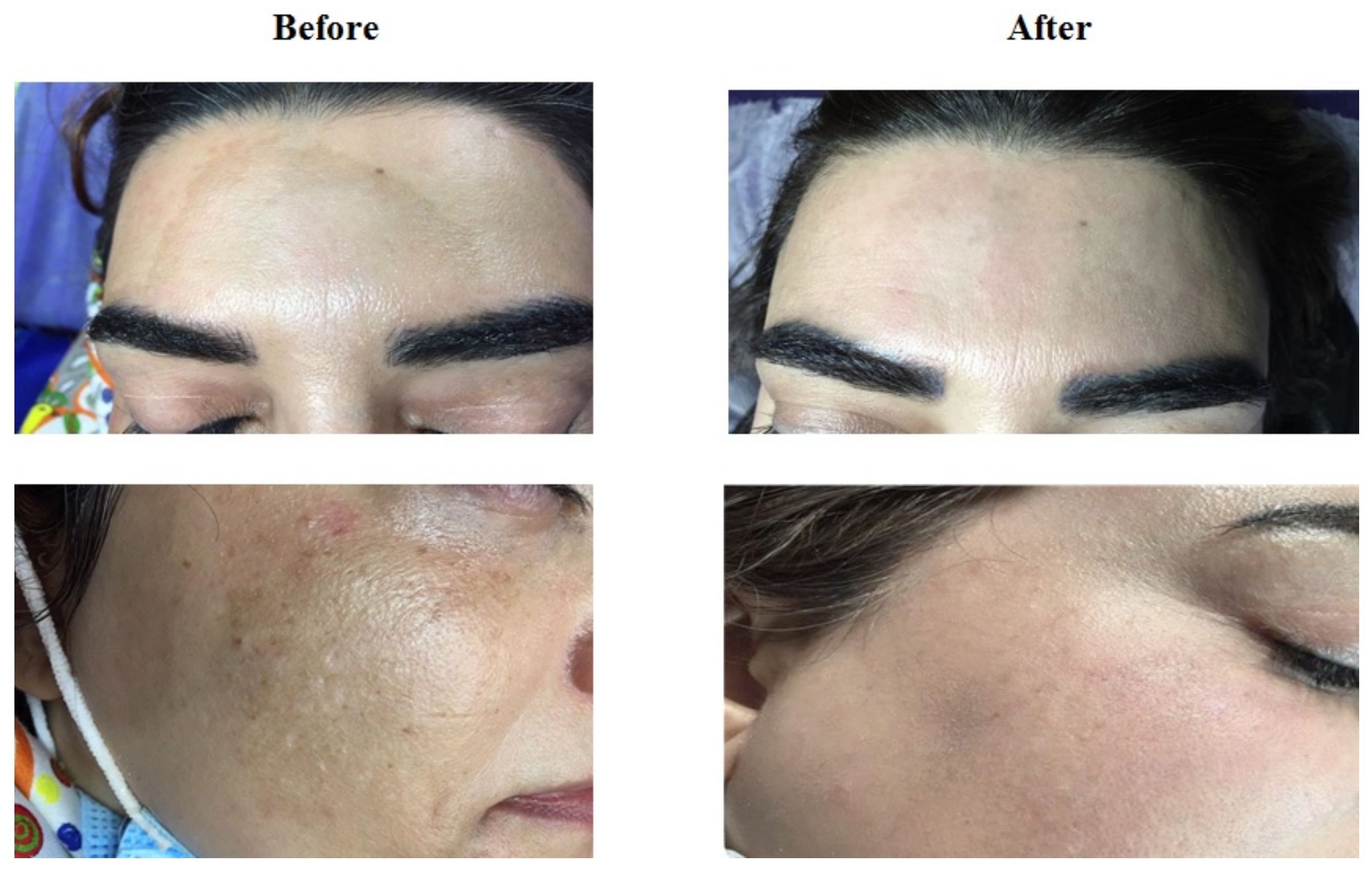 Cosmetics | Free Full-Text | Comparative Efficacy of Fractional CO2 Laser  and Q-Switched Nd:YAG Laser in Combination Therapy with Tranexamic Acid in  Refractory Melasma: Results of a Prospective Clinical Trial | HTML