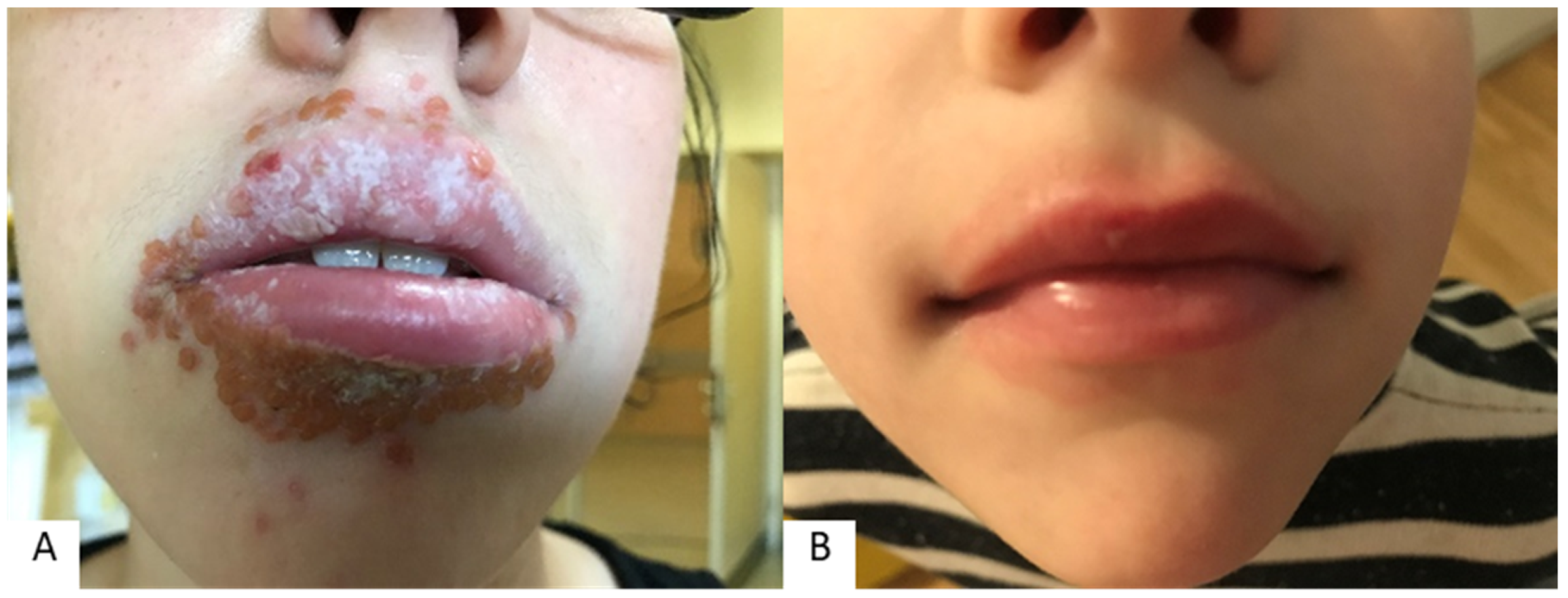 Cosmetics | Free Full-Text | Factors Participating in the Occurrence of  Inflammation of the Lips (Cheilitis) and Perioral Skin