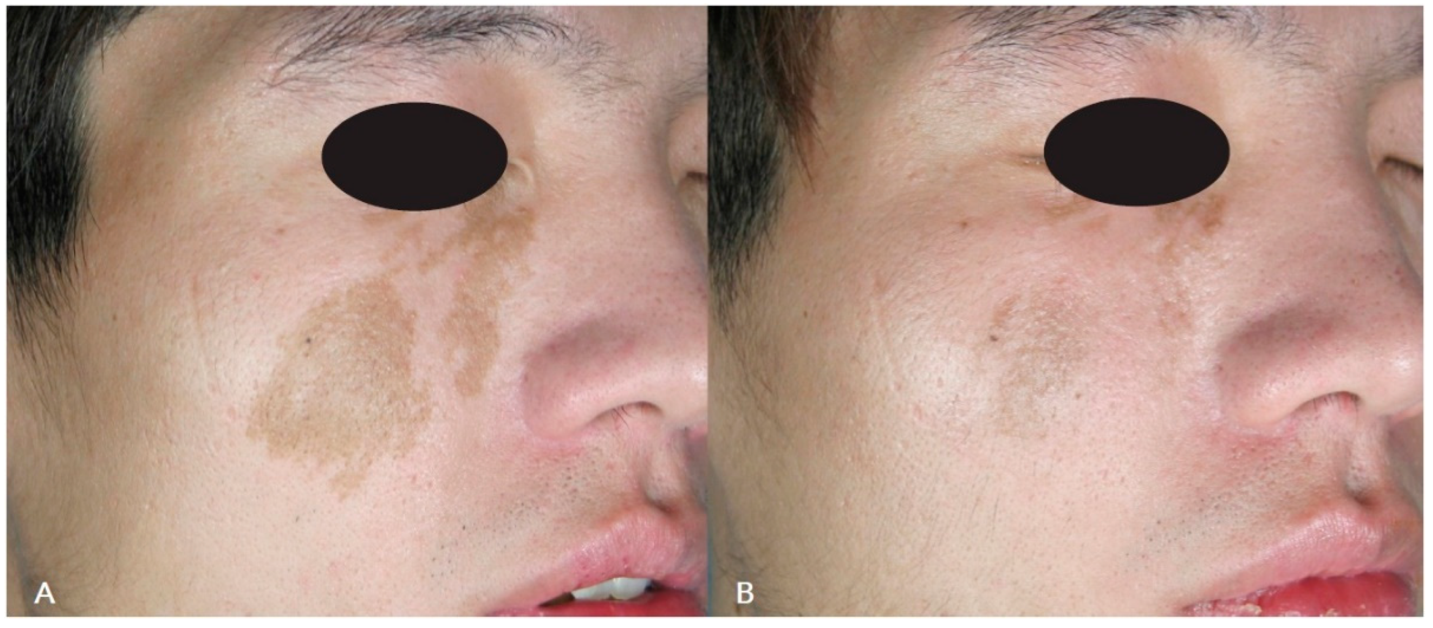 Cosmetics | Free Full-Text | Q-Switched Nd:YAG Laser to Manage  Hyperpigmentation in Asians: A Multicenter Study