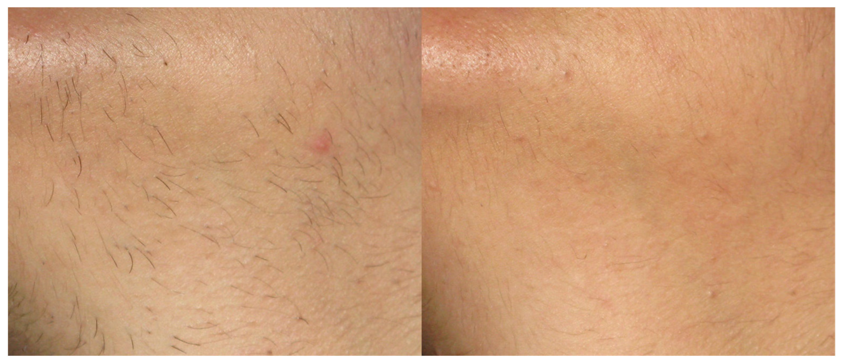 Views of a female groin (flashlamp treatment) before treatment (left)