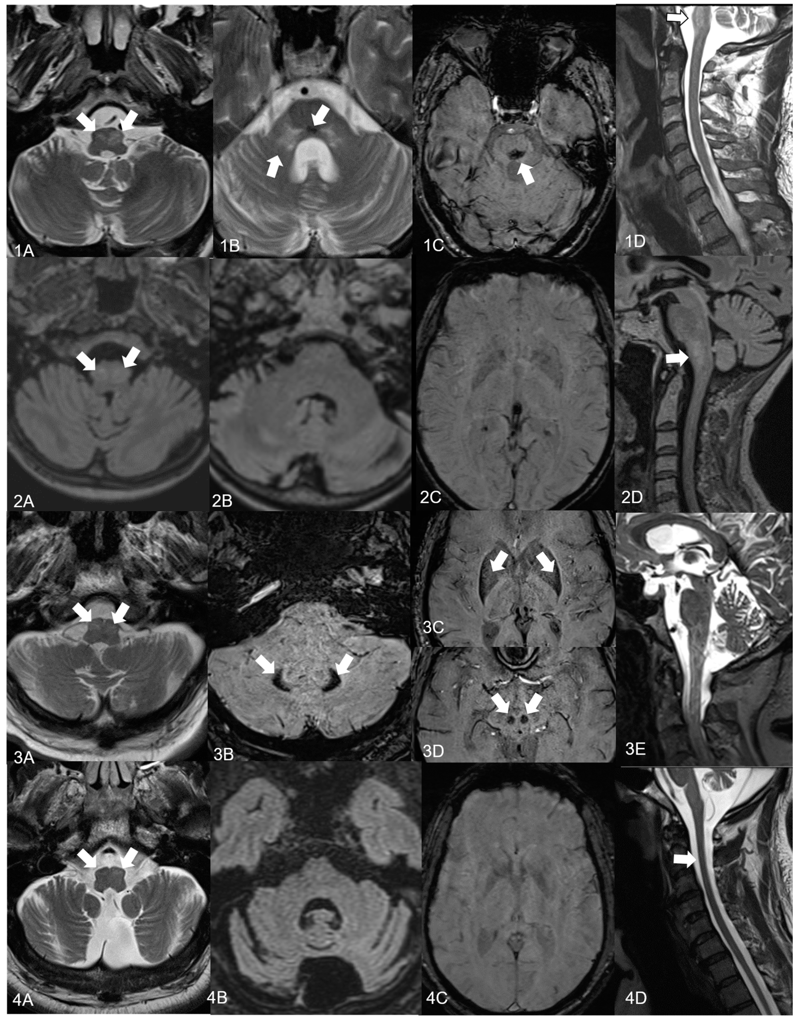 CTN | Free Full-Text | Four New Cases of Progressive Ataxia and Palatal  Tremor (PAPT) and a Literature Review