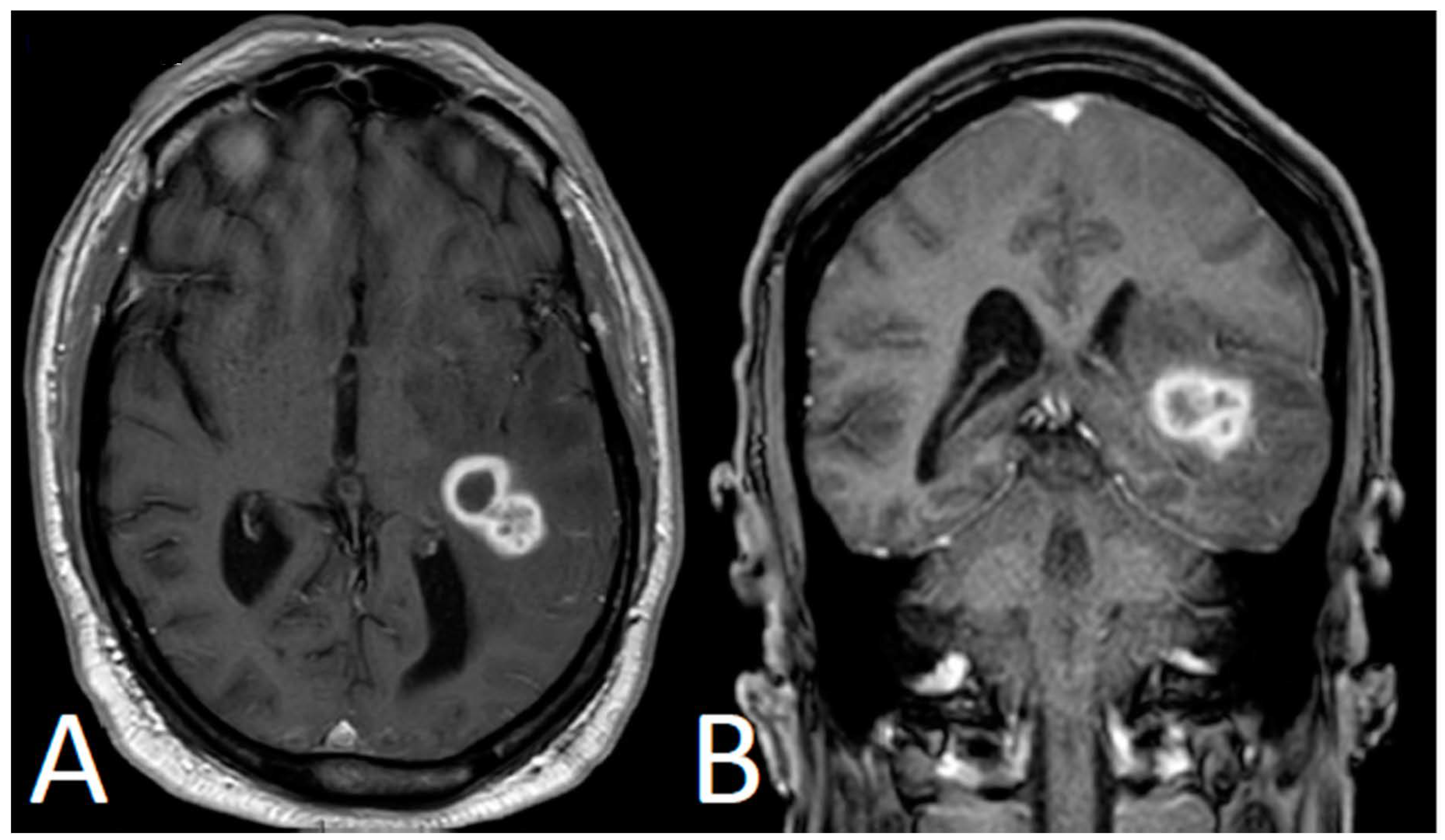 Current Oncology | Free Full-Text | Cerebral Invasive 