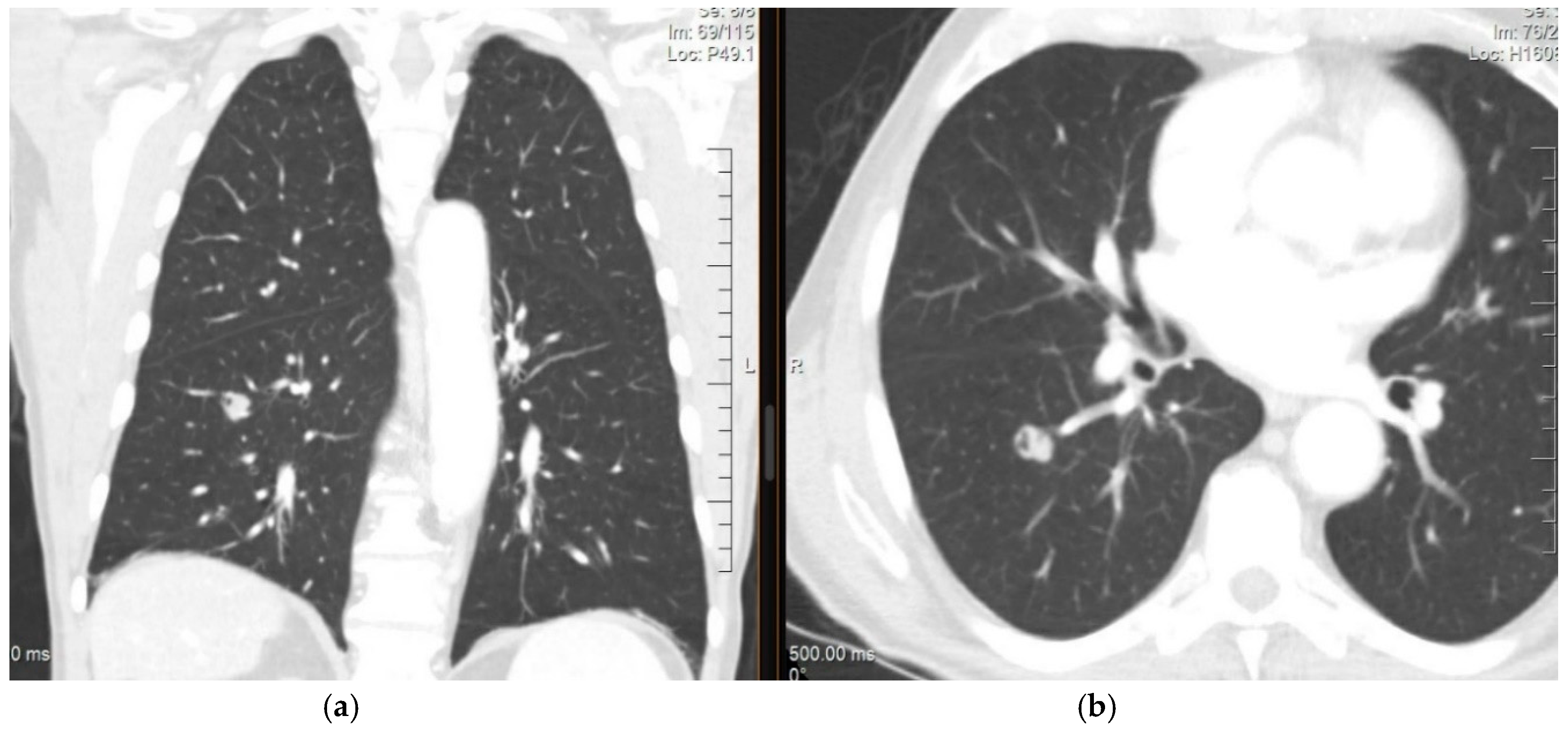 CA 27-29 in patients with breast cancer with pulmonary fibrosis