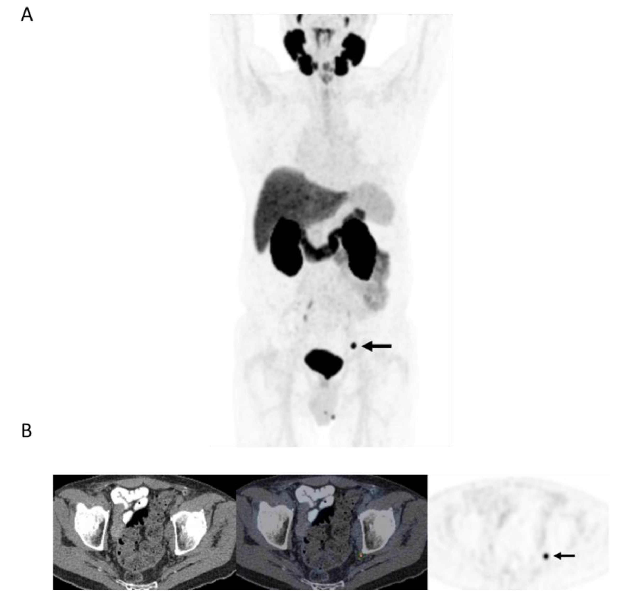 Changes in Management After 18F-DCFPyL PSMA PET in Patients