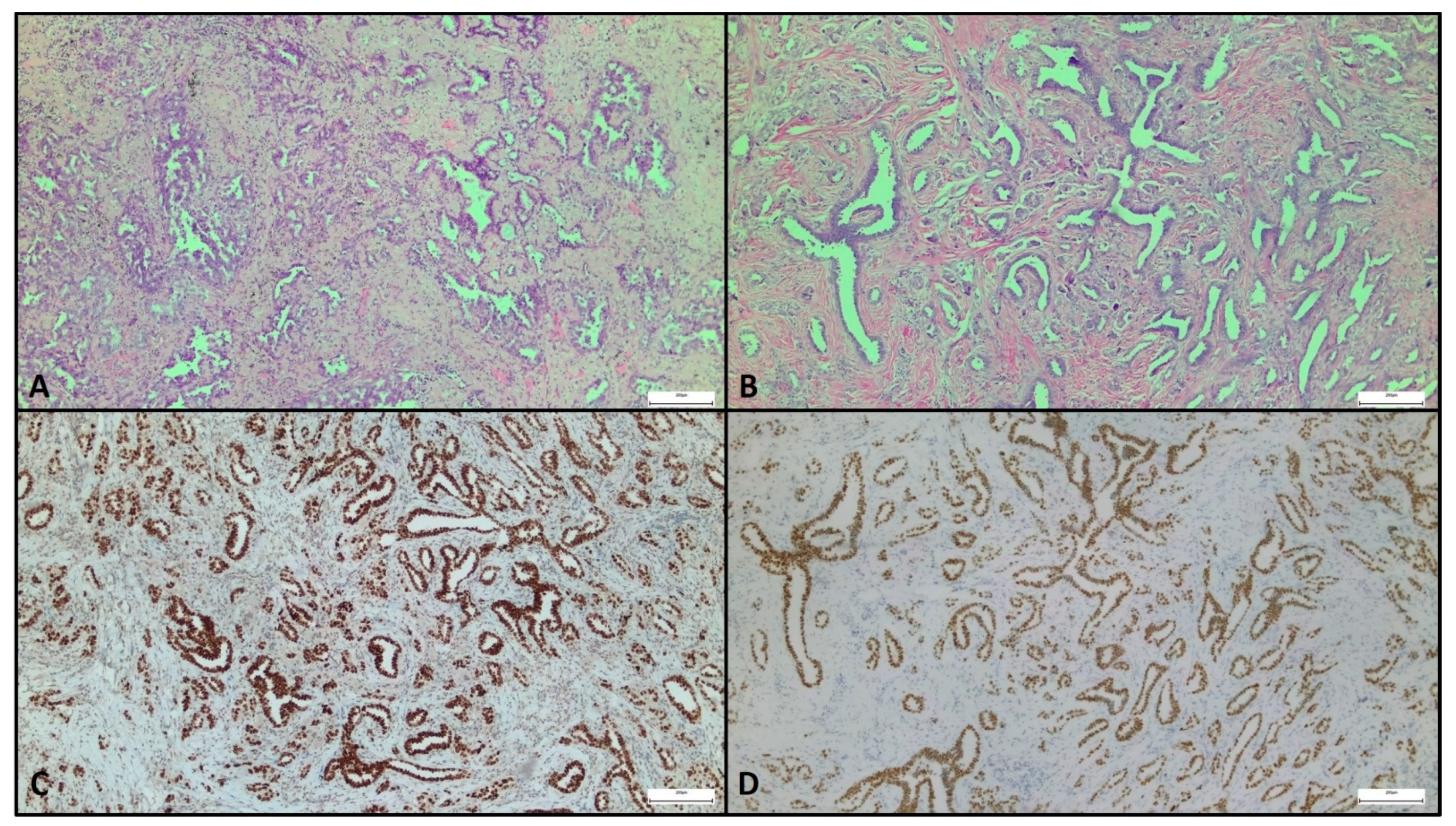 Current Oncology | Free Full-Text | Complex Differential Diagnosis between  Primary Breast Cancer and Breast Metastasis from EGFR-Mutated Lung  Adenocarcinoma: Case Report and Literature Review