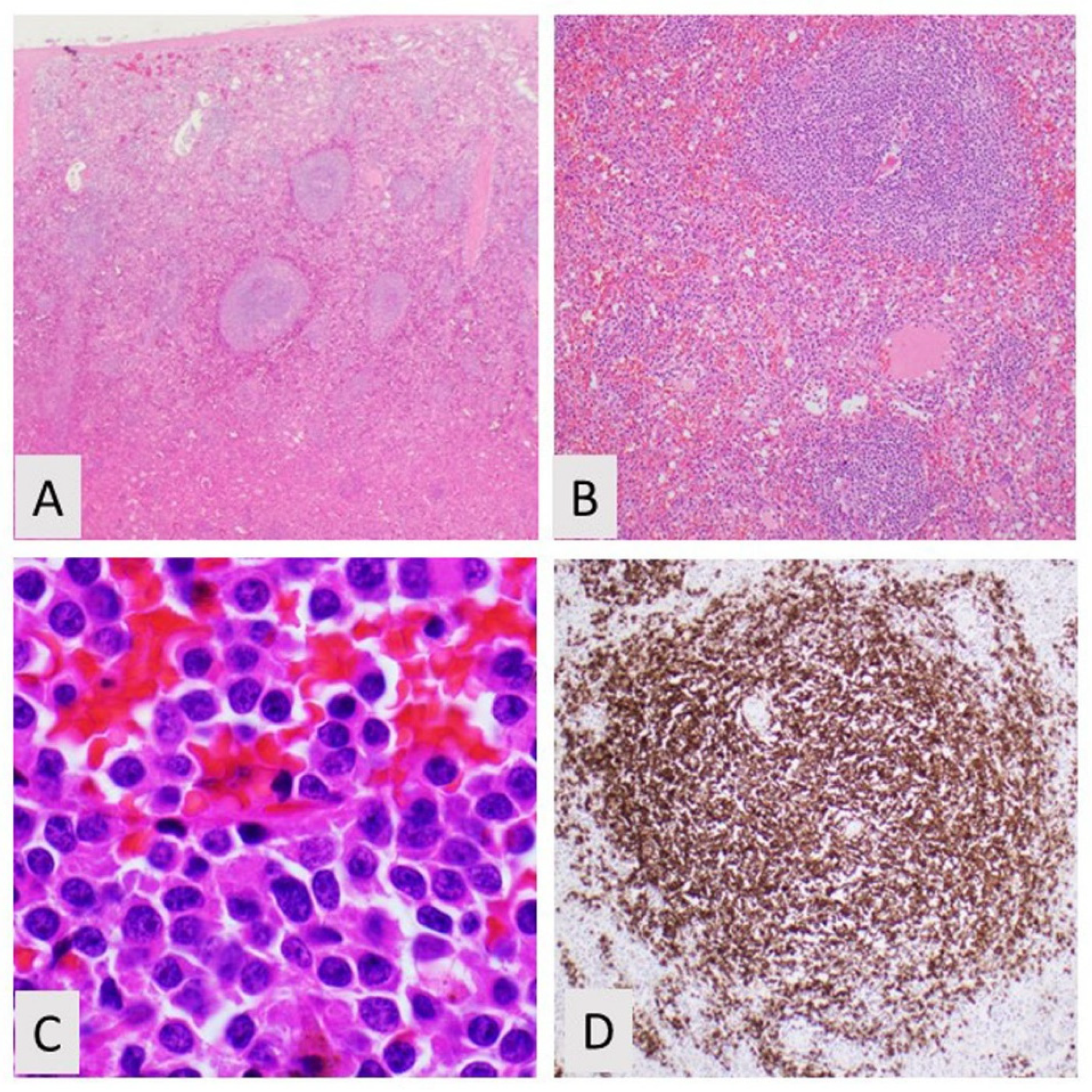 Current Oncology | Free Full-Text | CD5-Negative, CD10-Negative Low-Grade B-Cell  Lymphoproliferative Disorders of the Spleen