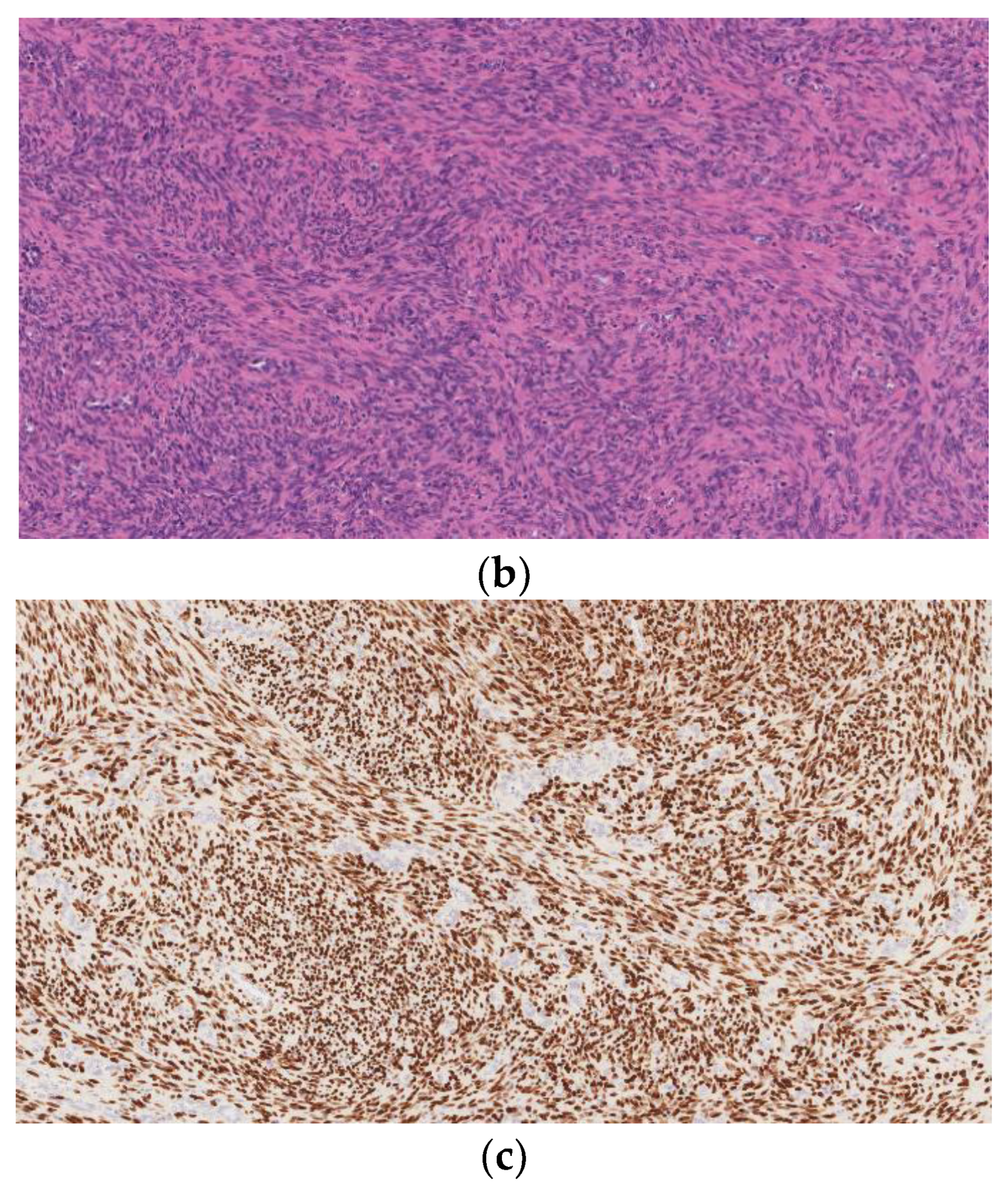 Frontiers  Nodular and diffuse spindle cell infiltration in keloidal  scleroderma: a case report