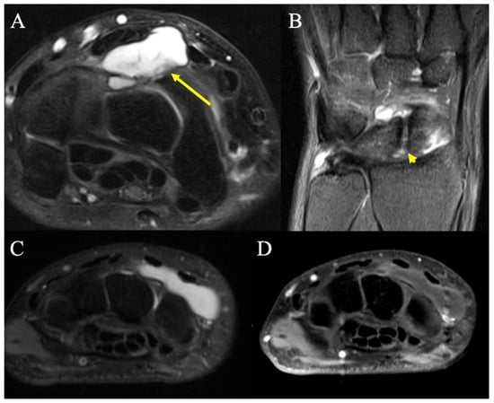 Soft, symmetrical, bulky tumors on the back