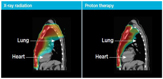 Proton Therapy for Breast Cancer