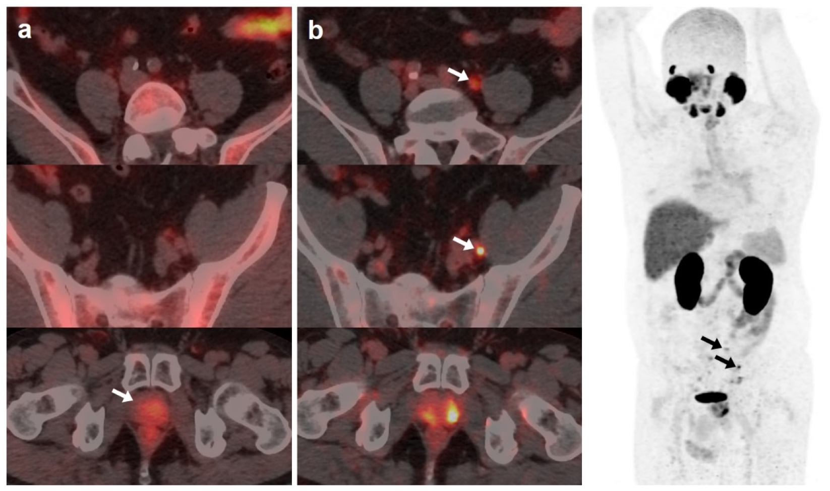 Changes in Management After 18F-DCFPyL PSMA PET in Patients