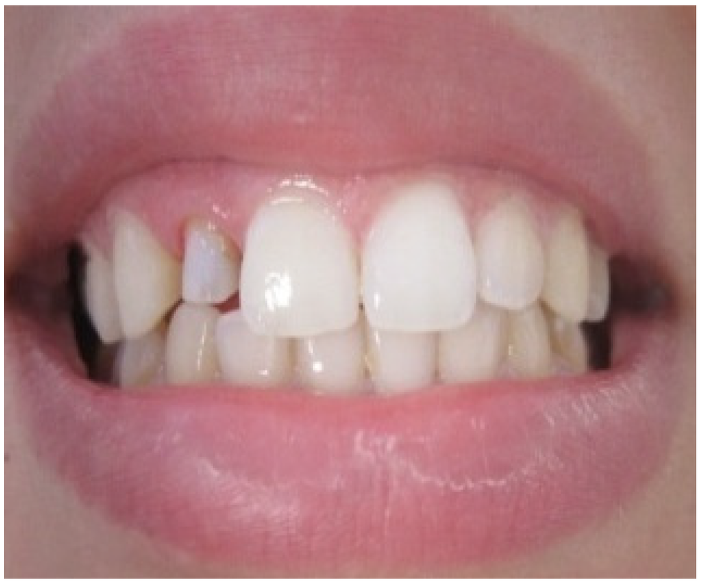 Dentistry Journal | Free Full-Text | Gingival Harmony in Anterior