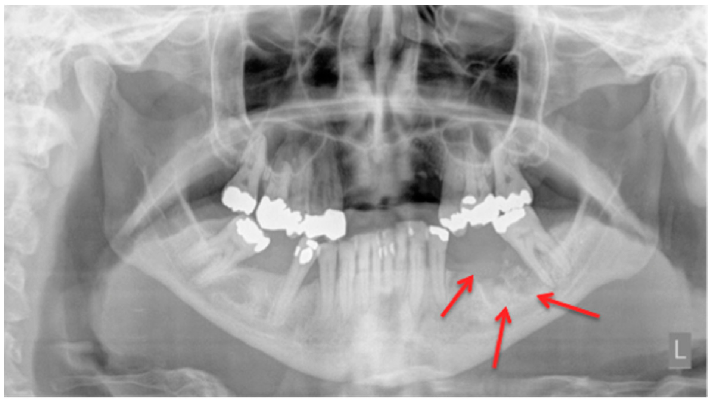 bisphosphonate associated osteonecrosis of the jaw