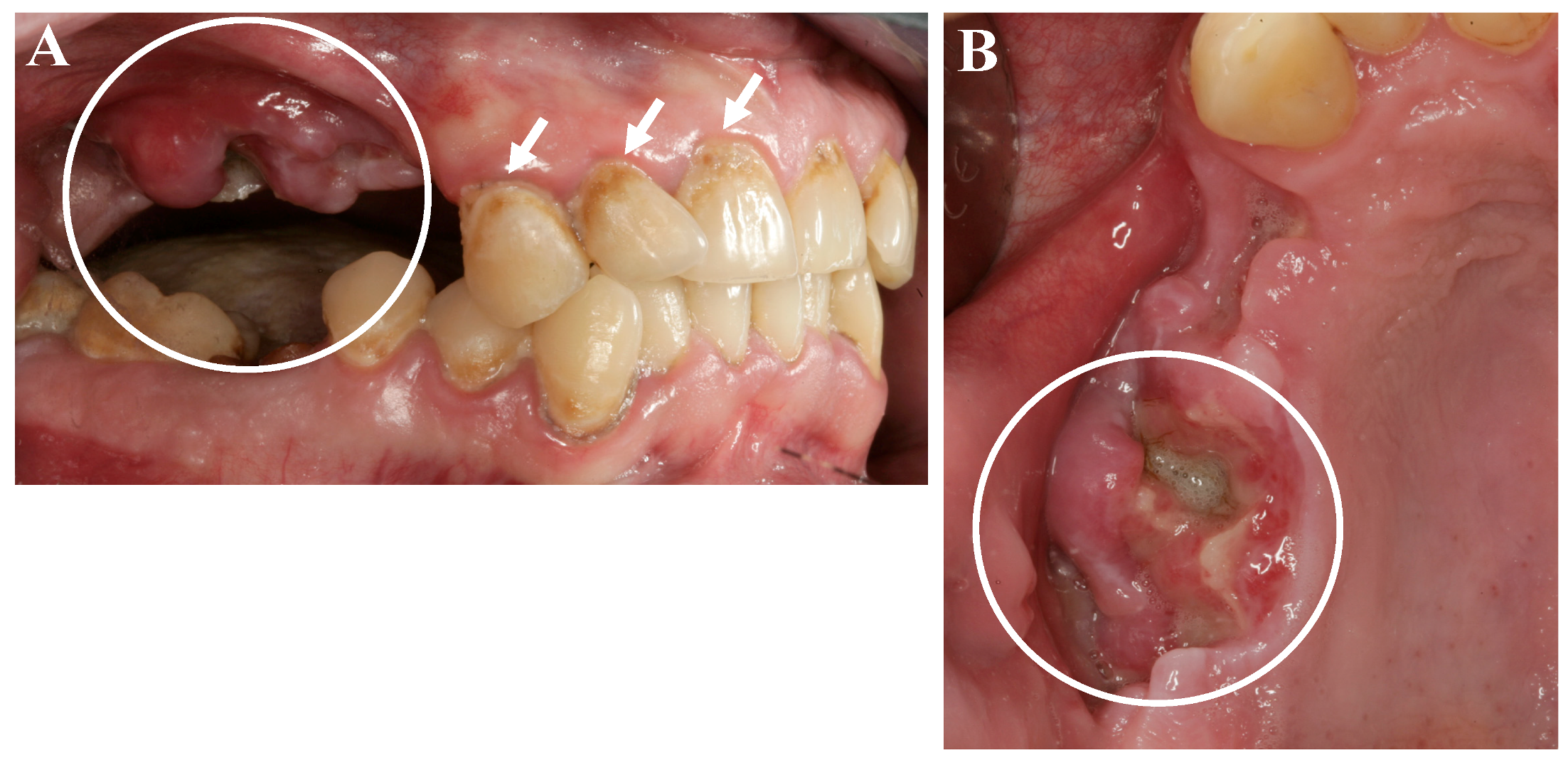 Dentistry Journal | Free Full-Text | Meth Mouth—A Growing Epidemic in  Dentistry?