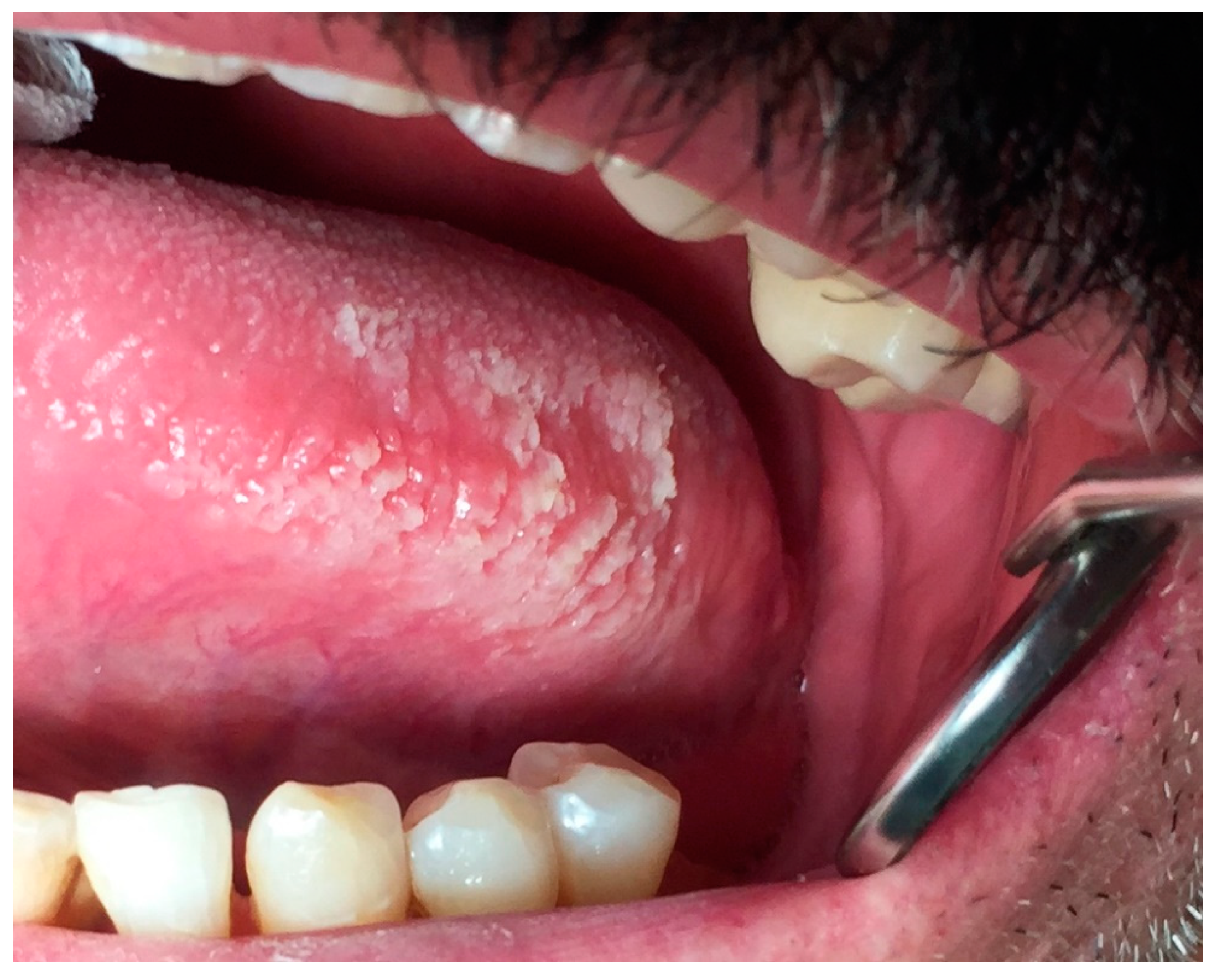 Dentistry Journal Free Full Text Oral White Lesions An