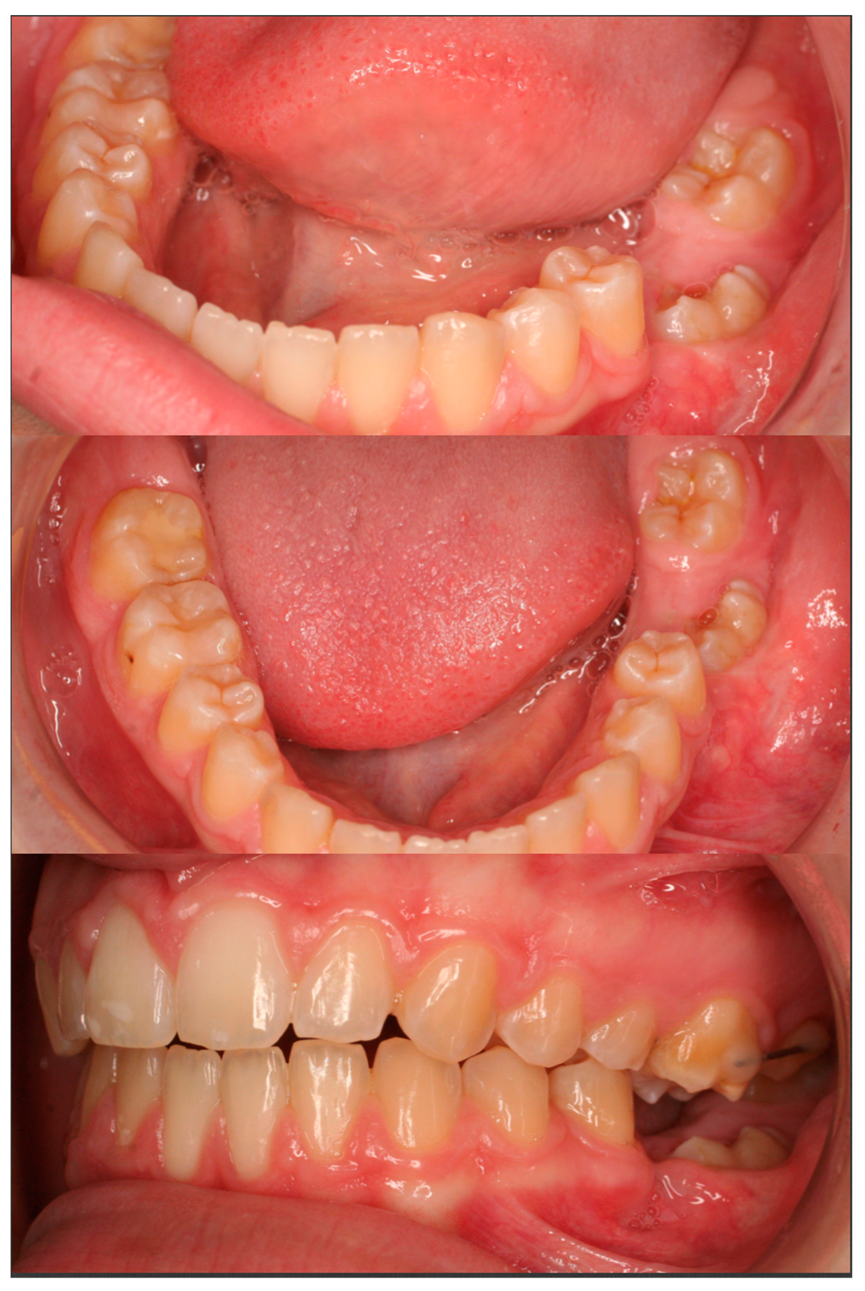 molar cyst mandibular missing impacted journal permanent uprighting dentistry second