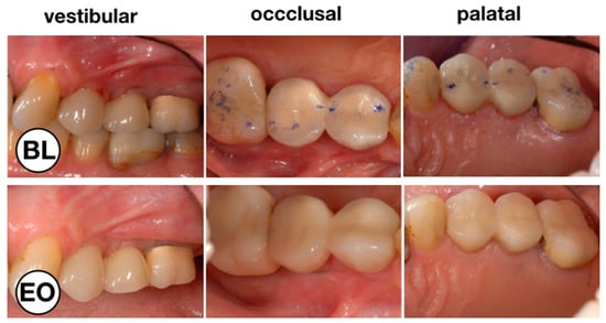 Dentistry Journal Free Full Text Treatment Of Peri Implant Mucositis With Repeated Application Of Chlorhexidine Chips Or Gel During Supportive Therapy A Randomized Clinical Trial Html