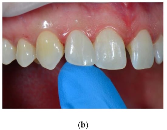 Dentistry Journal June 2020 Browse Articles