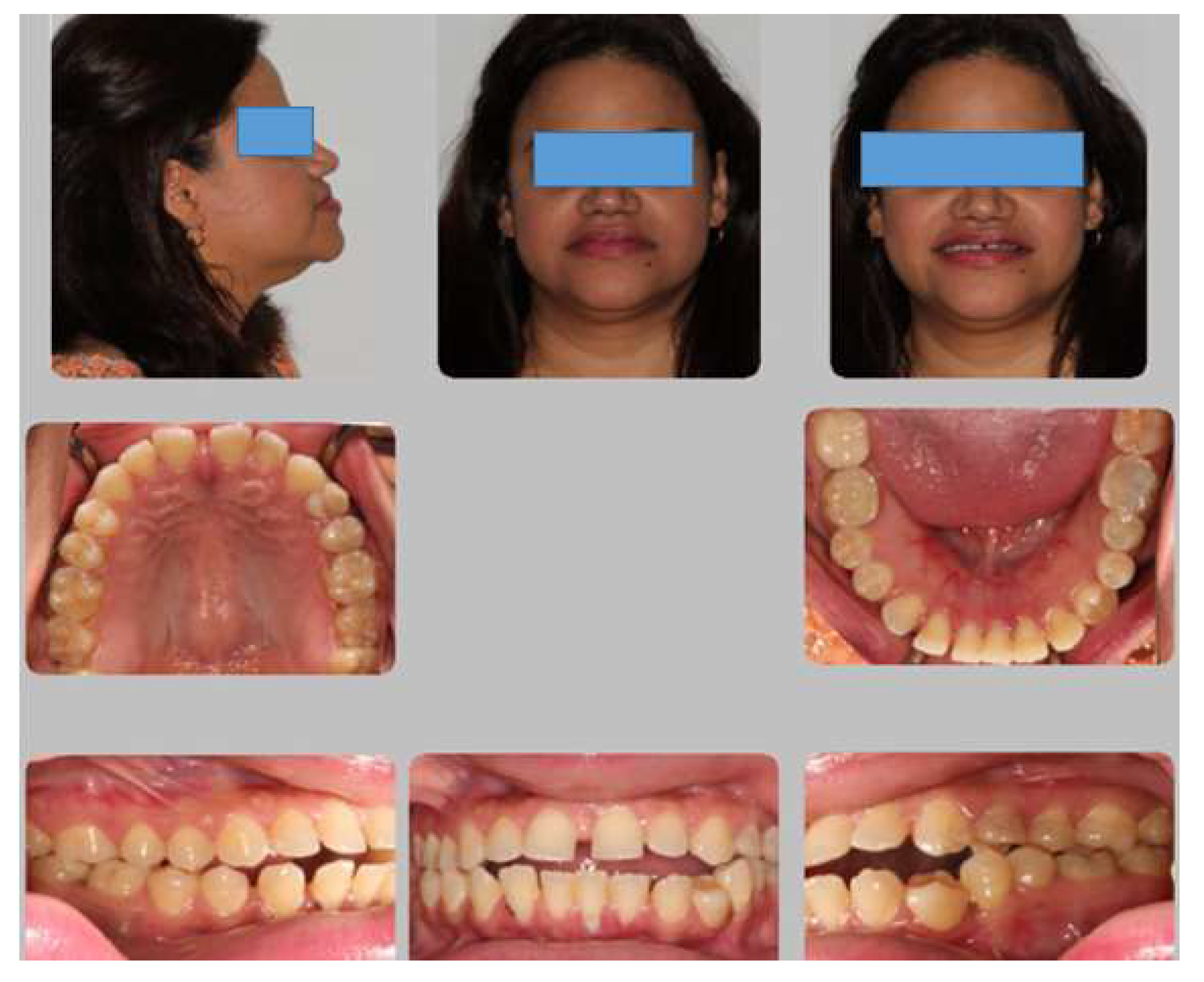 Fixing an Overbite with Crowns: Does It Work? - Vera Smile