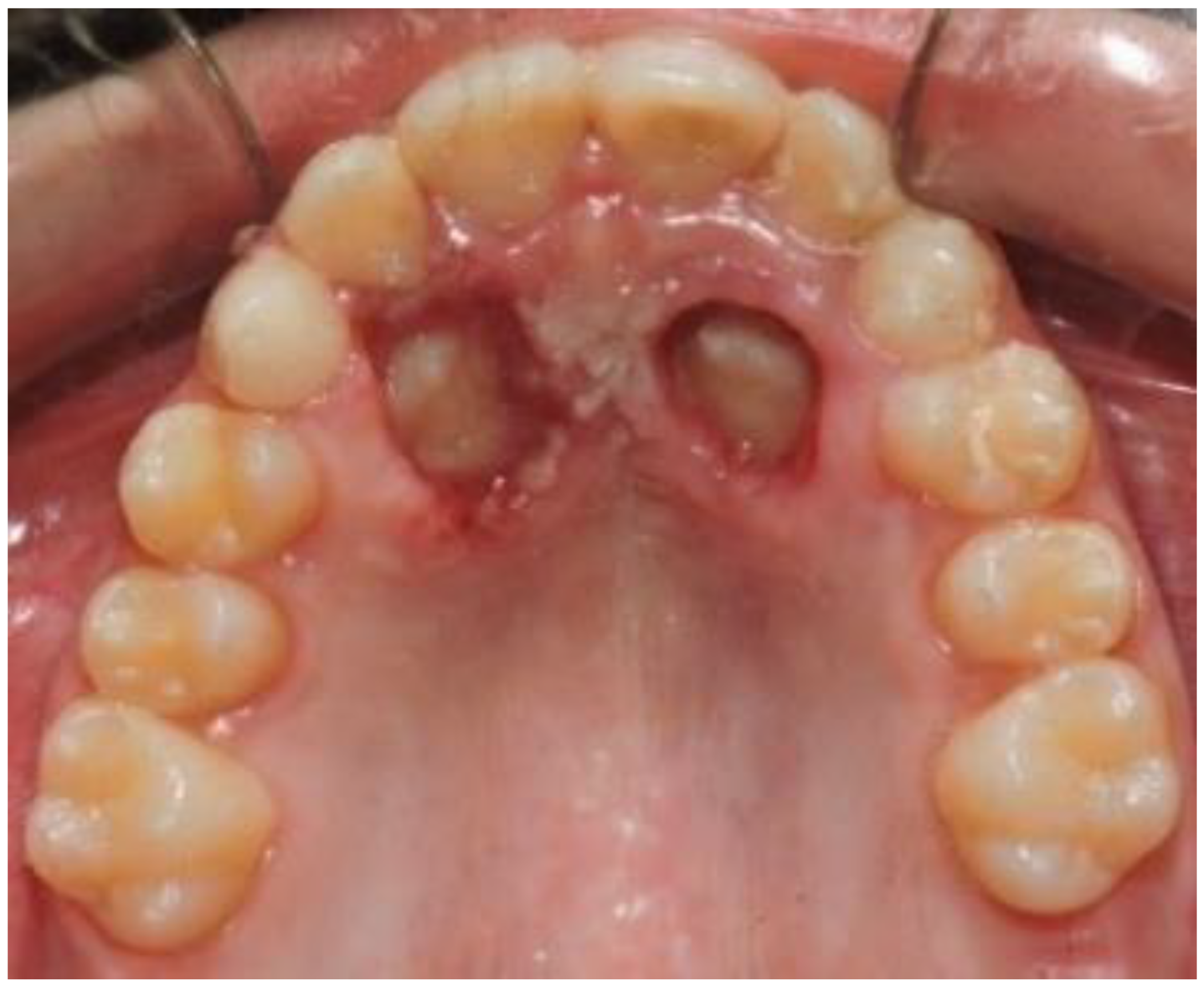 Dentistry Journal Free Full Text Uncovering And Autonomous Eruption