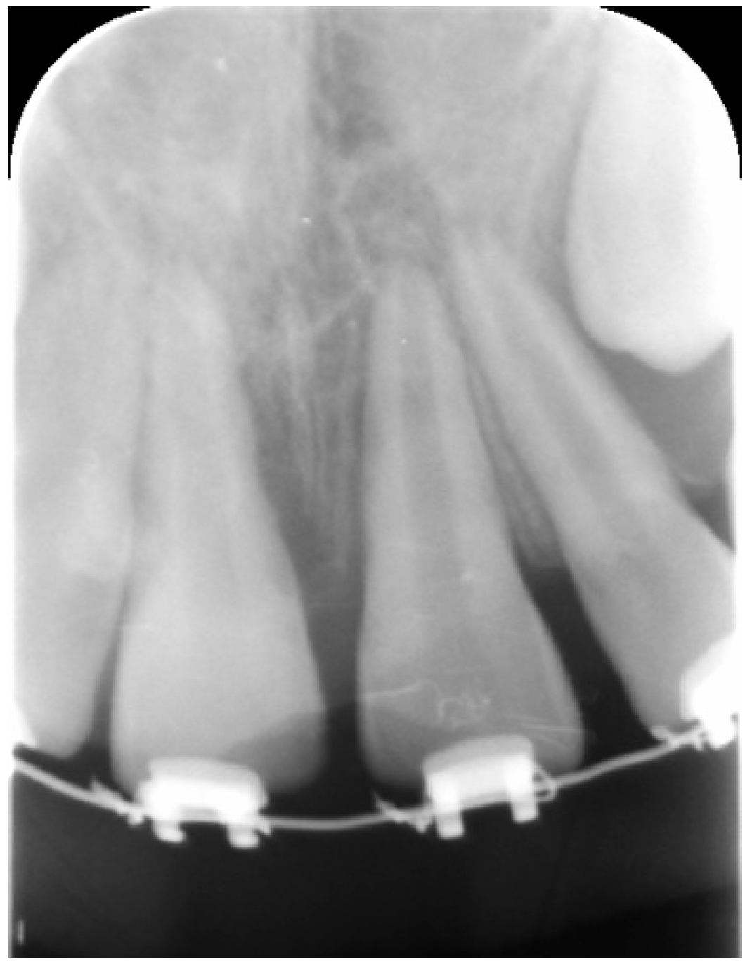 external resorption of tooth