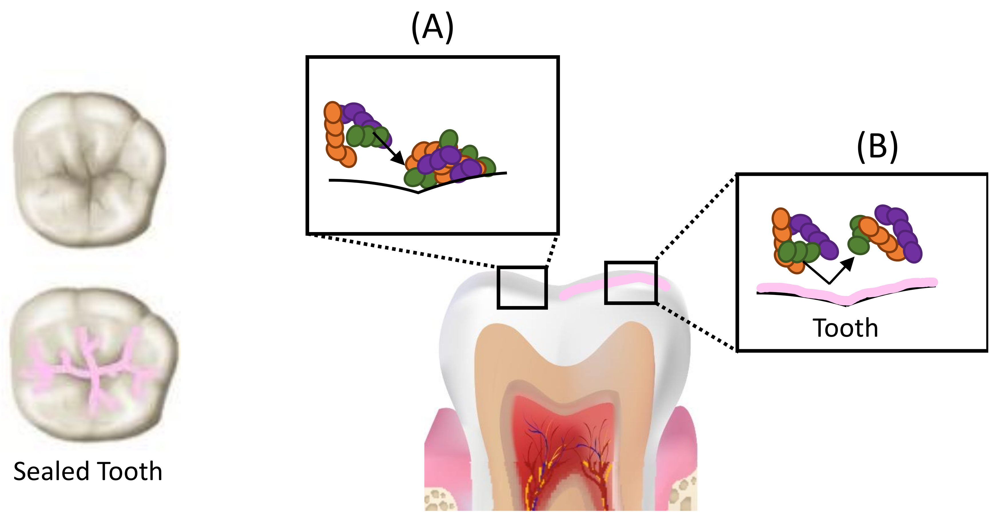 Dentistry Journal | Free Full-Text | Minimally Invasive Therapies for the  Management of Dental Caries&mdash;A Literature Review