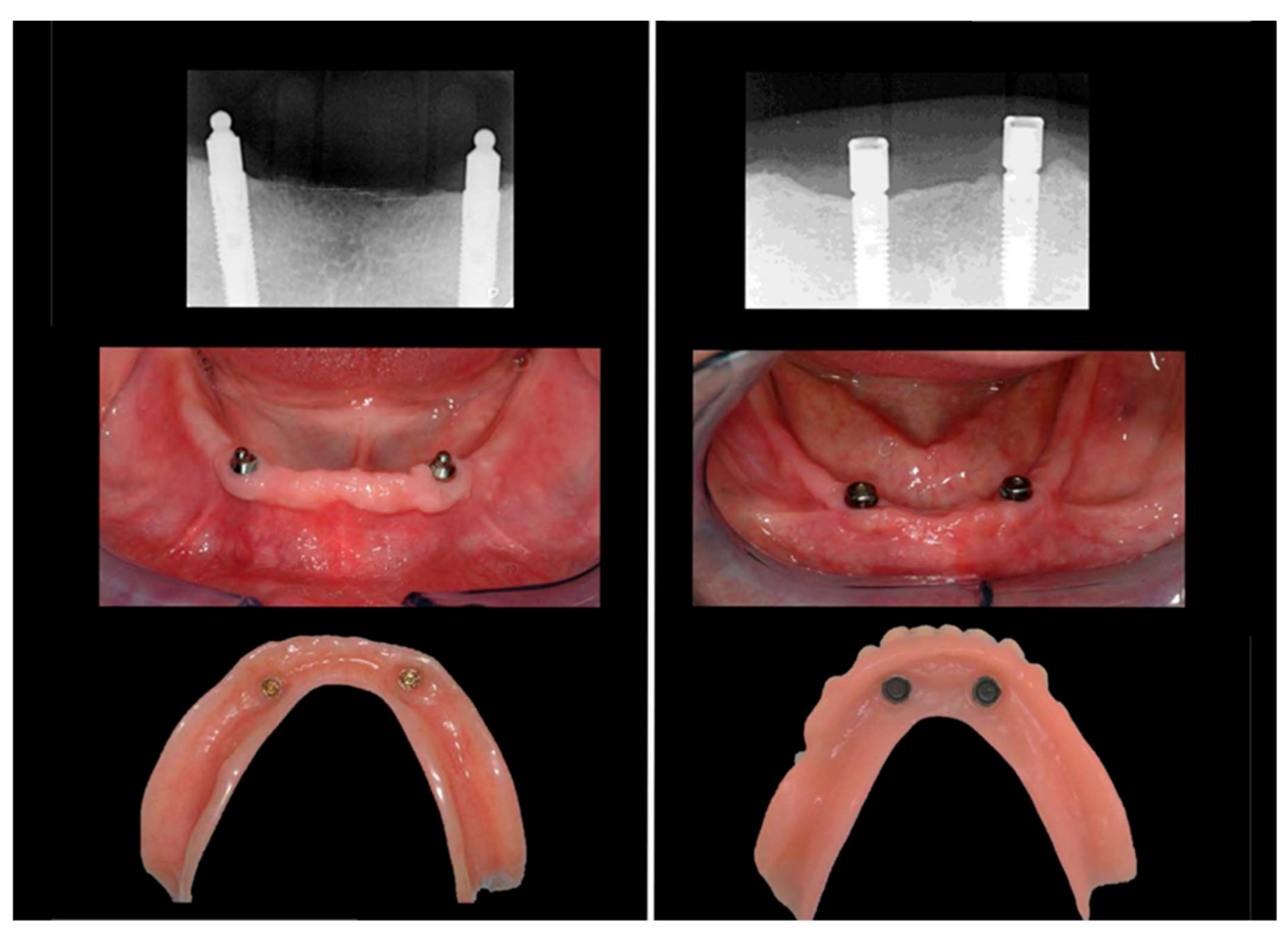 PDF) Conventional radiofrequency treatment in five patients with