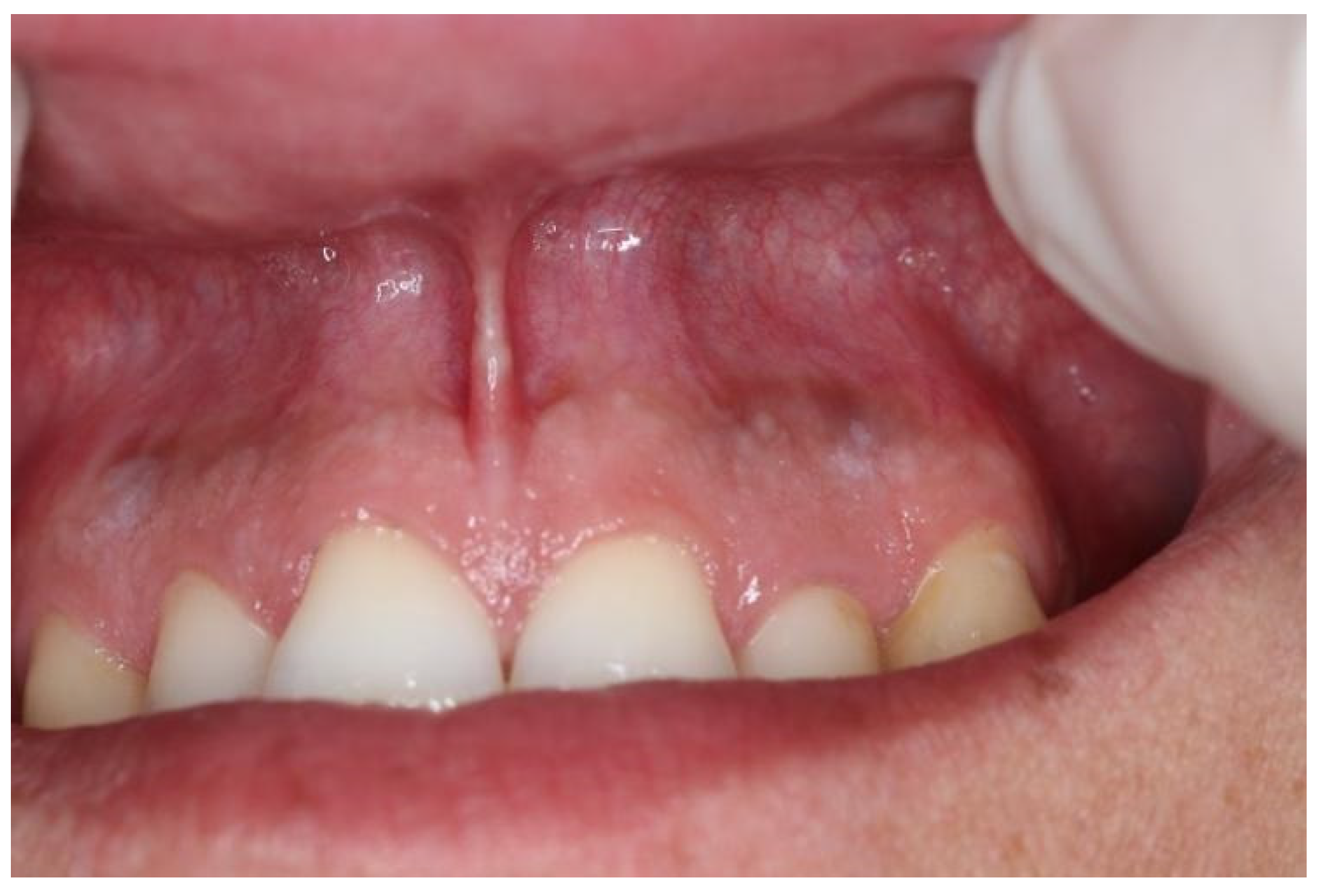 Dentistry Journal | Free Full-Text | The Correlation of Swedish Snus,  Nicotine Pouches and Other Tobacco Products with Oral Mucosal Health and  Salivary Biomarkers