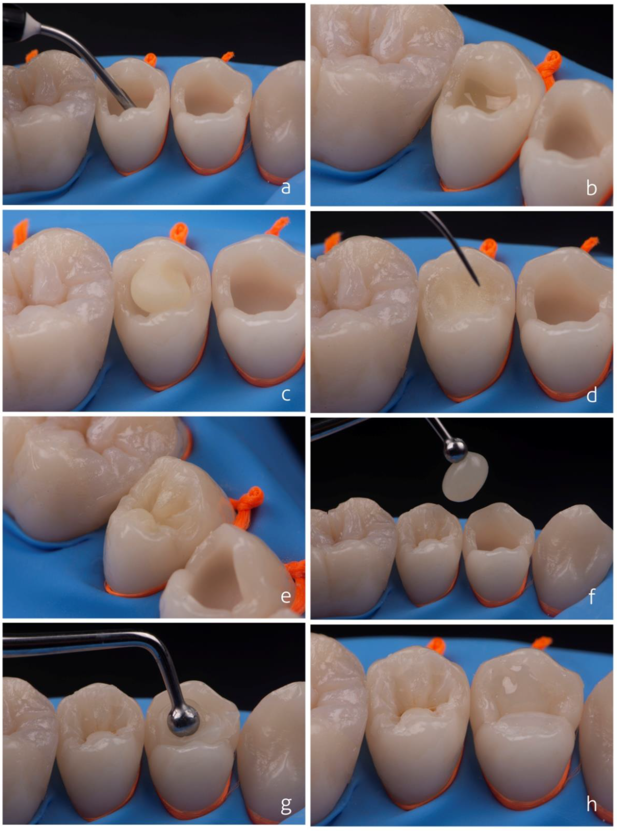 Step by Step Dental Filling (Cavity Filling - Tooth Filling): Cusp Build-Up  of a Molar 