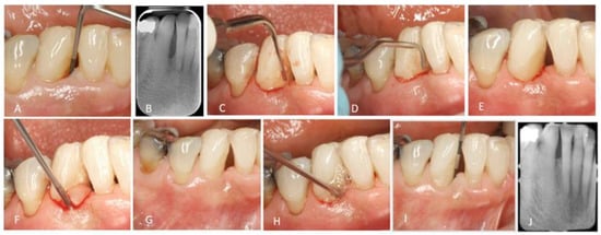 PDF) Ultrasonic Surgical Aspirator to Treat Deep Infrabony Defects: A New  Flapless Minimally Invasive Approach