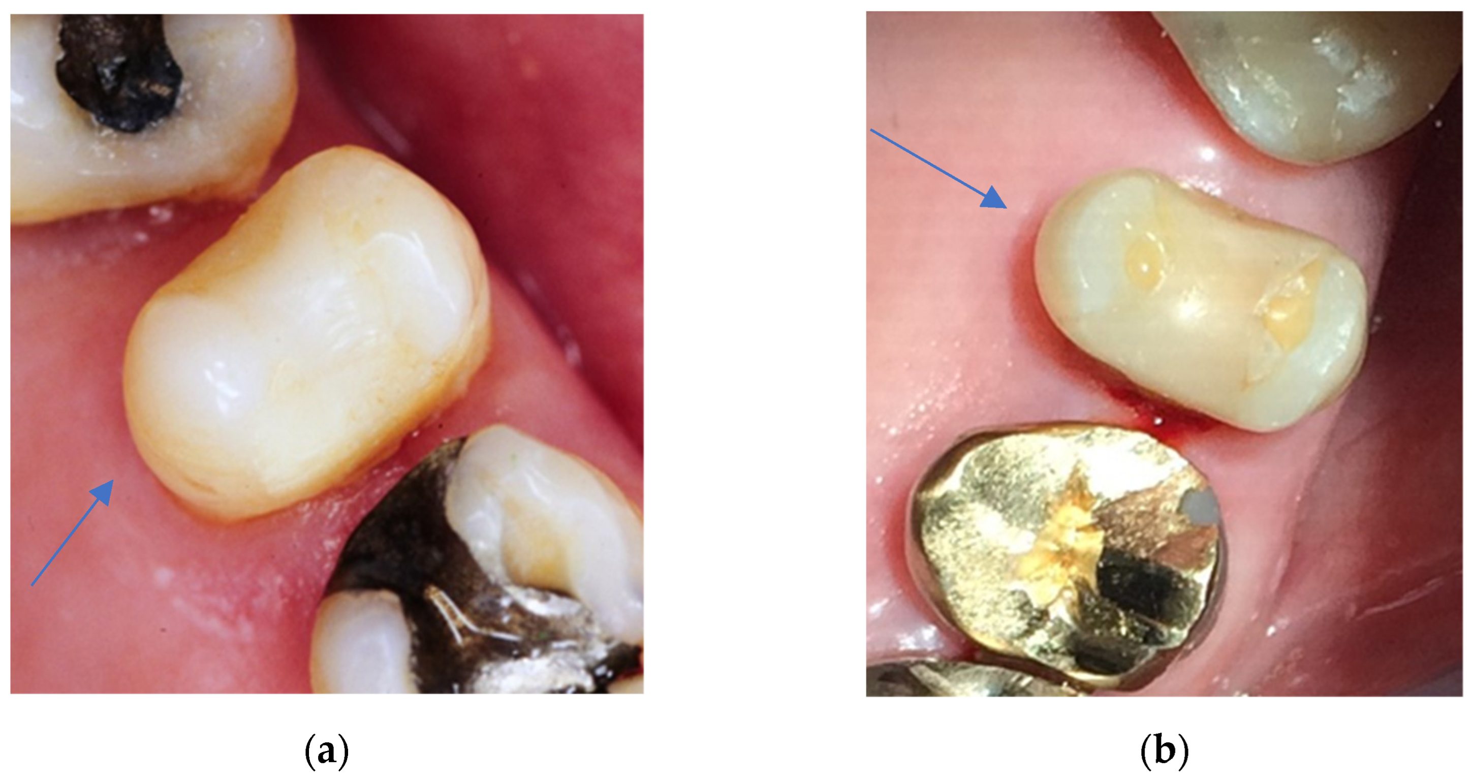 Dentistry 11 00069 g004 Dentistry 11 00069 g004