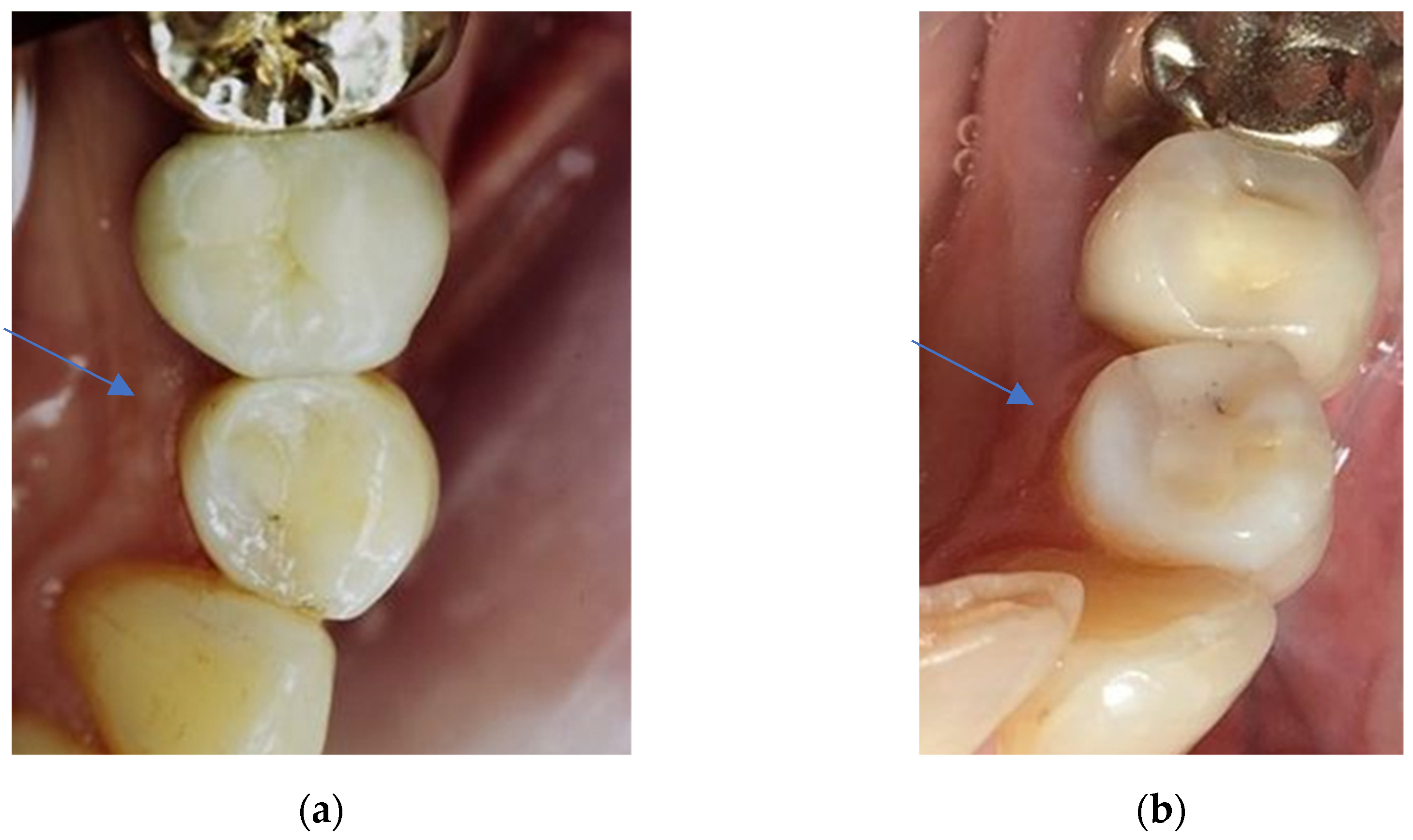 Dentistry 11 00069 g006 Dentistry 11 00069 g006