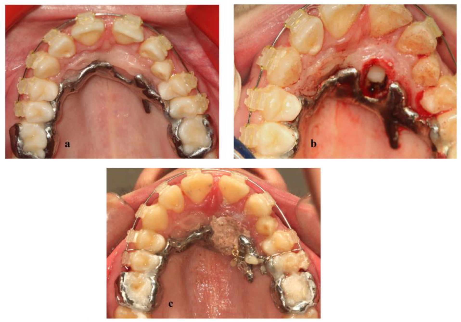 Dentistry Journal Free FullText Orthodontic Treatment of Palatally