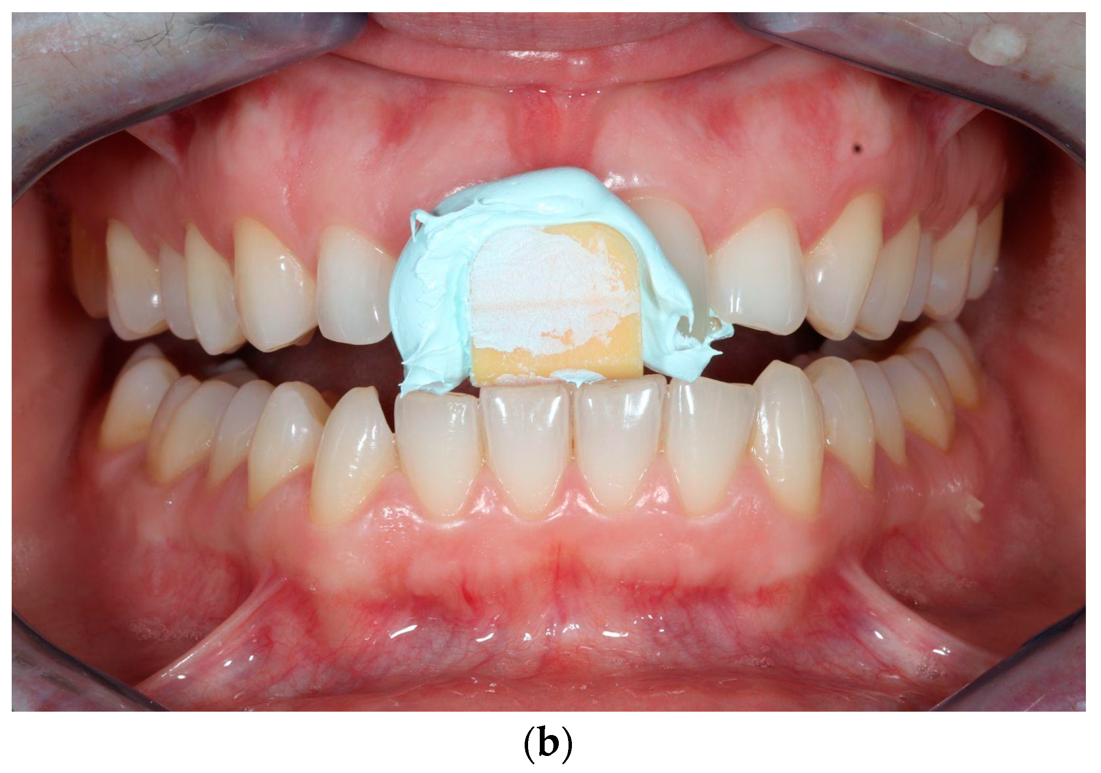 Dentistry 11 00126 g002b Dentistry 11 00126 g002b