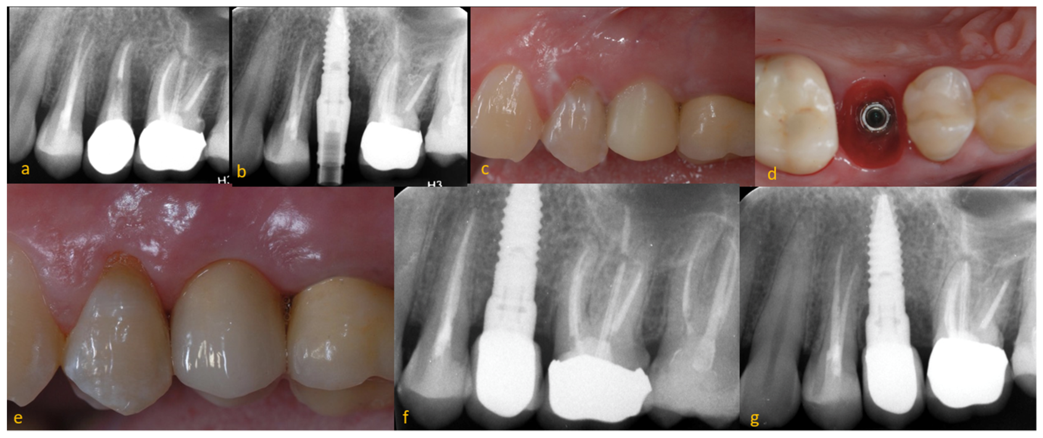 Dentistry 11 00185 g001 Dentistry 11 00185 g001