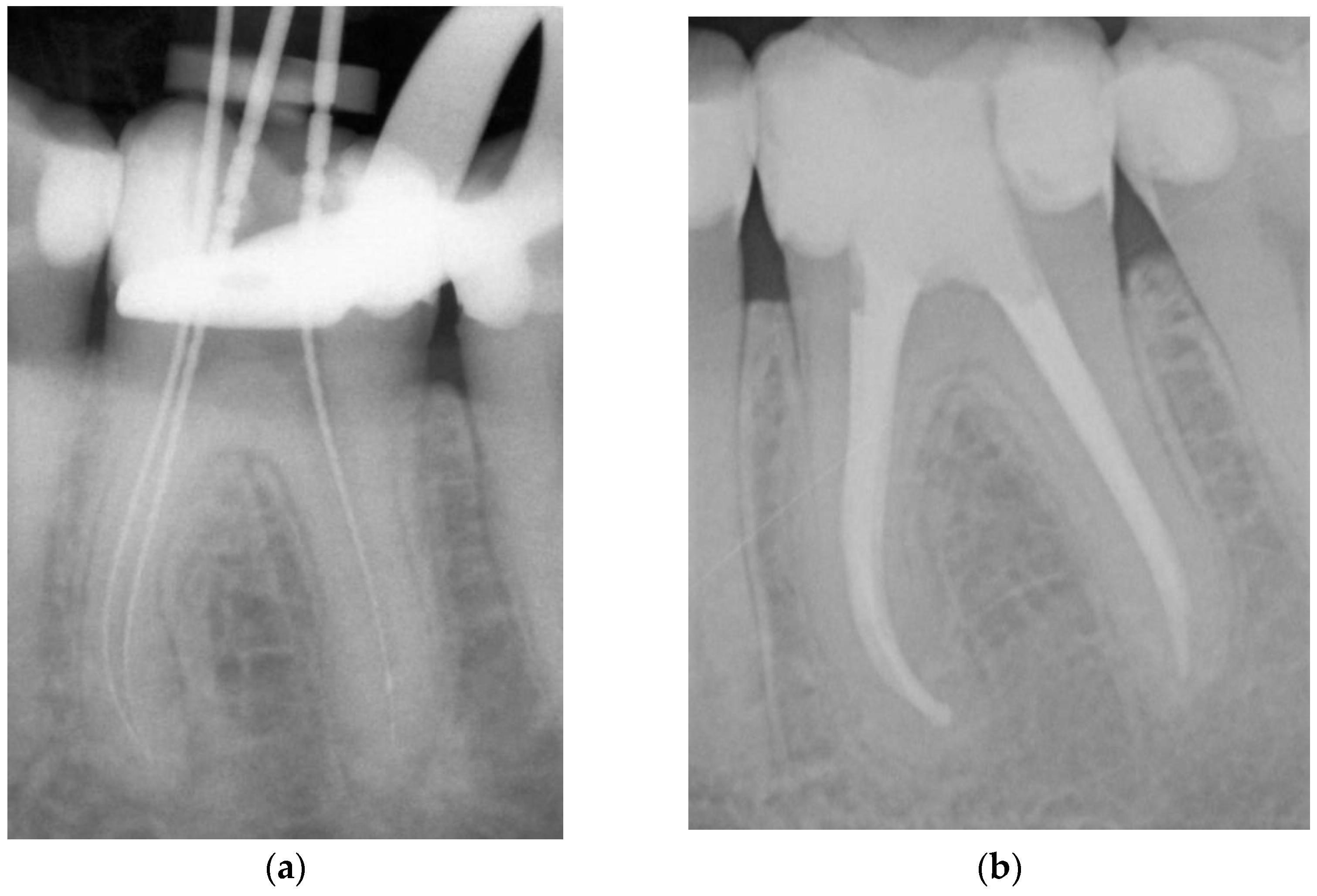 Dentistry Journal | Free Full-Text | Endodontic Outcome of Root