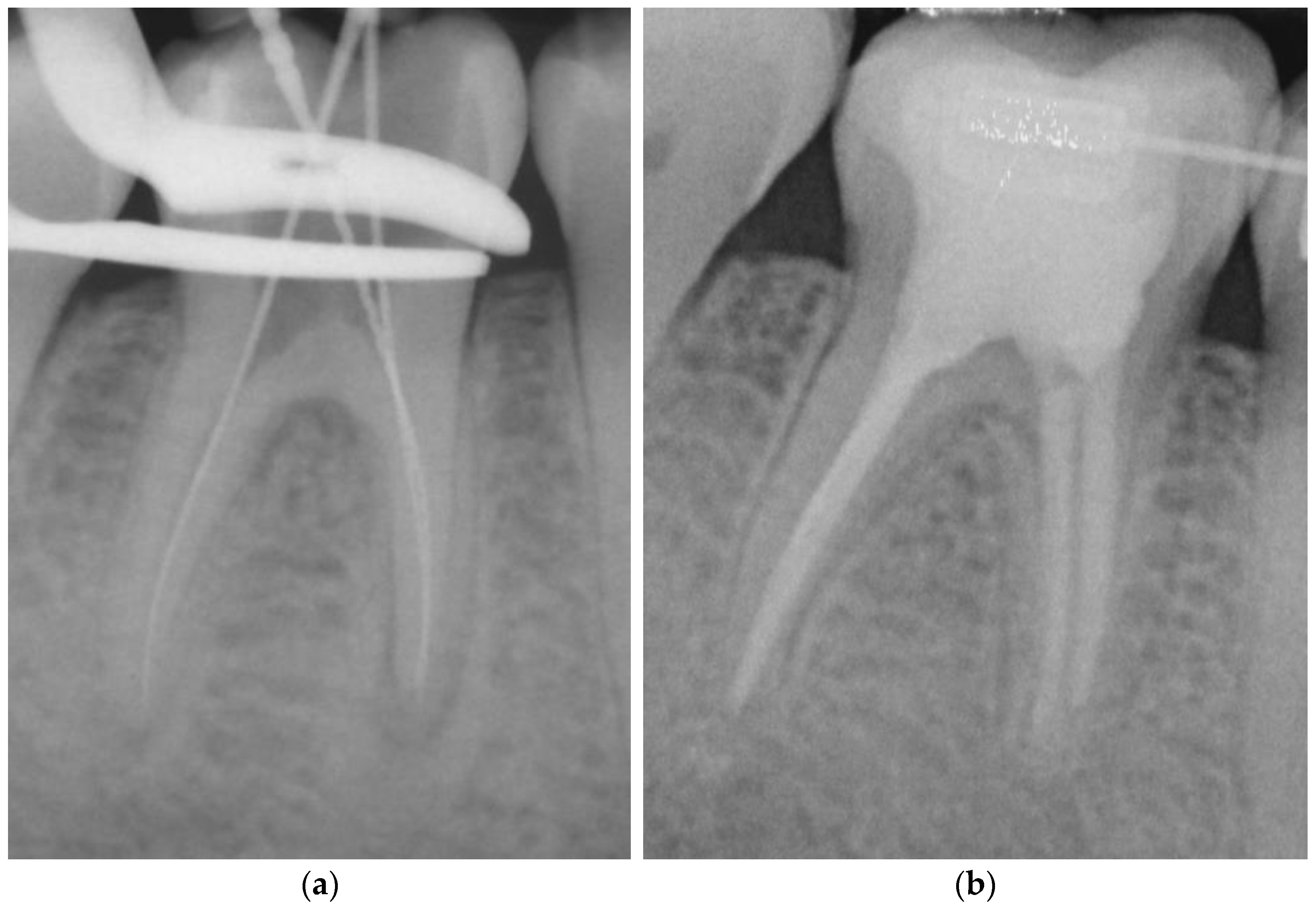 Dentistry Journal Free FullText Endodontic of Root Canal