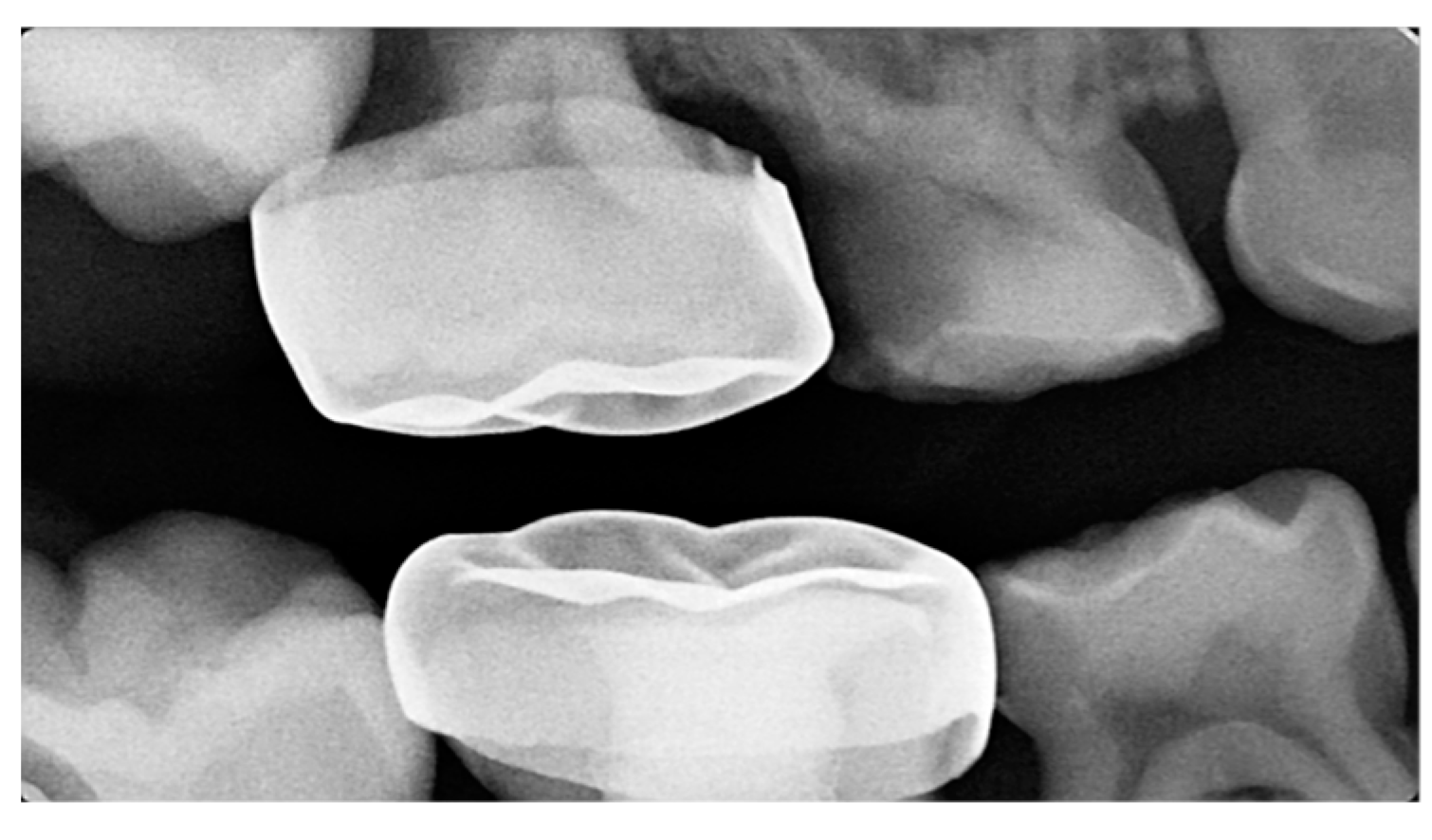 Dentistry Journal Free Full Text Ectopic Permanent Molars A Review 3210