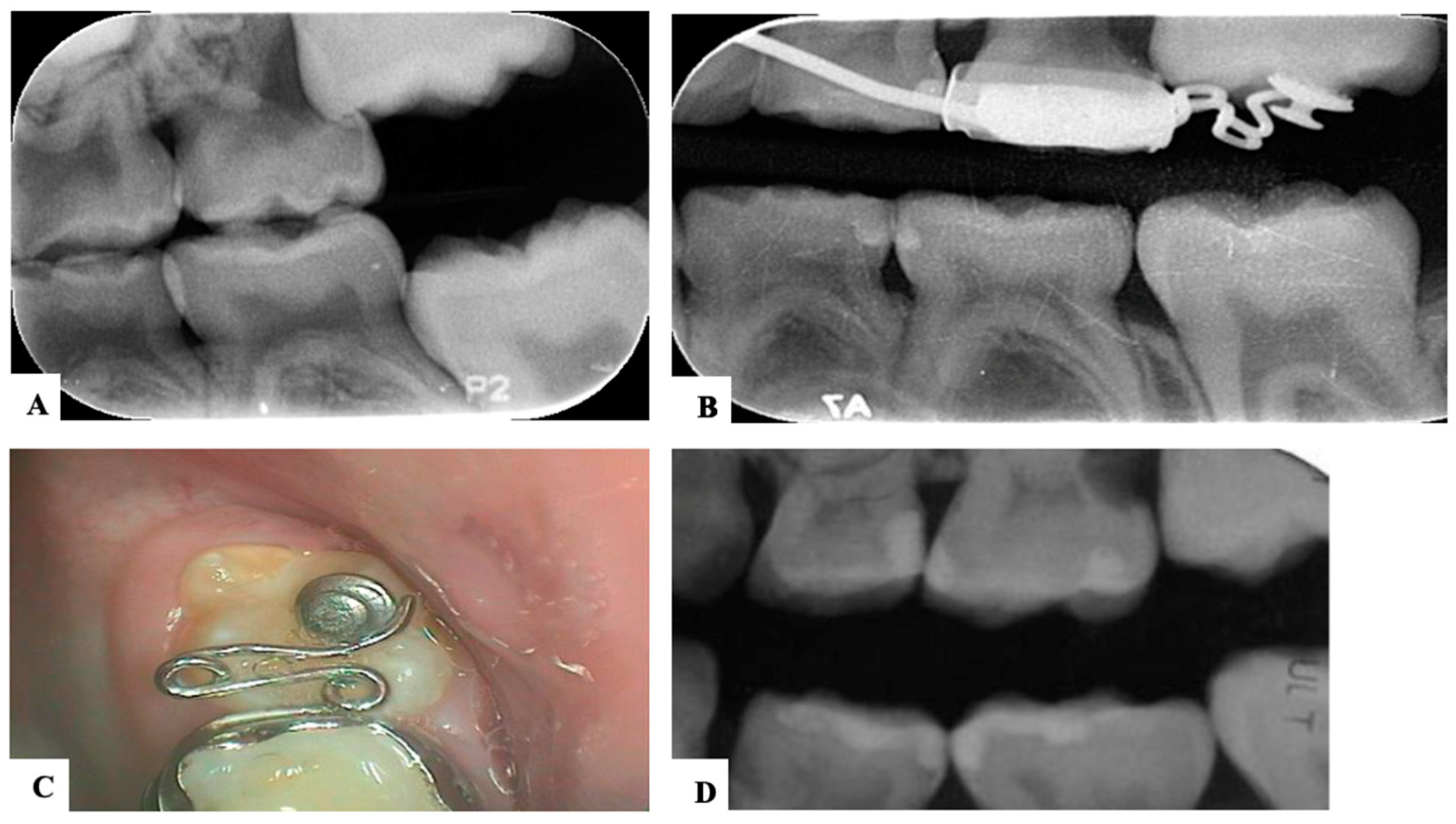 Dentistry Journal Free Full Text Ectopic Permanent Molars A Review 8721