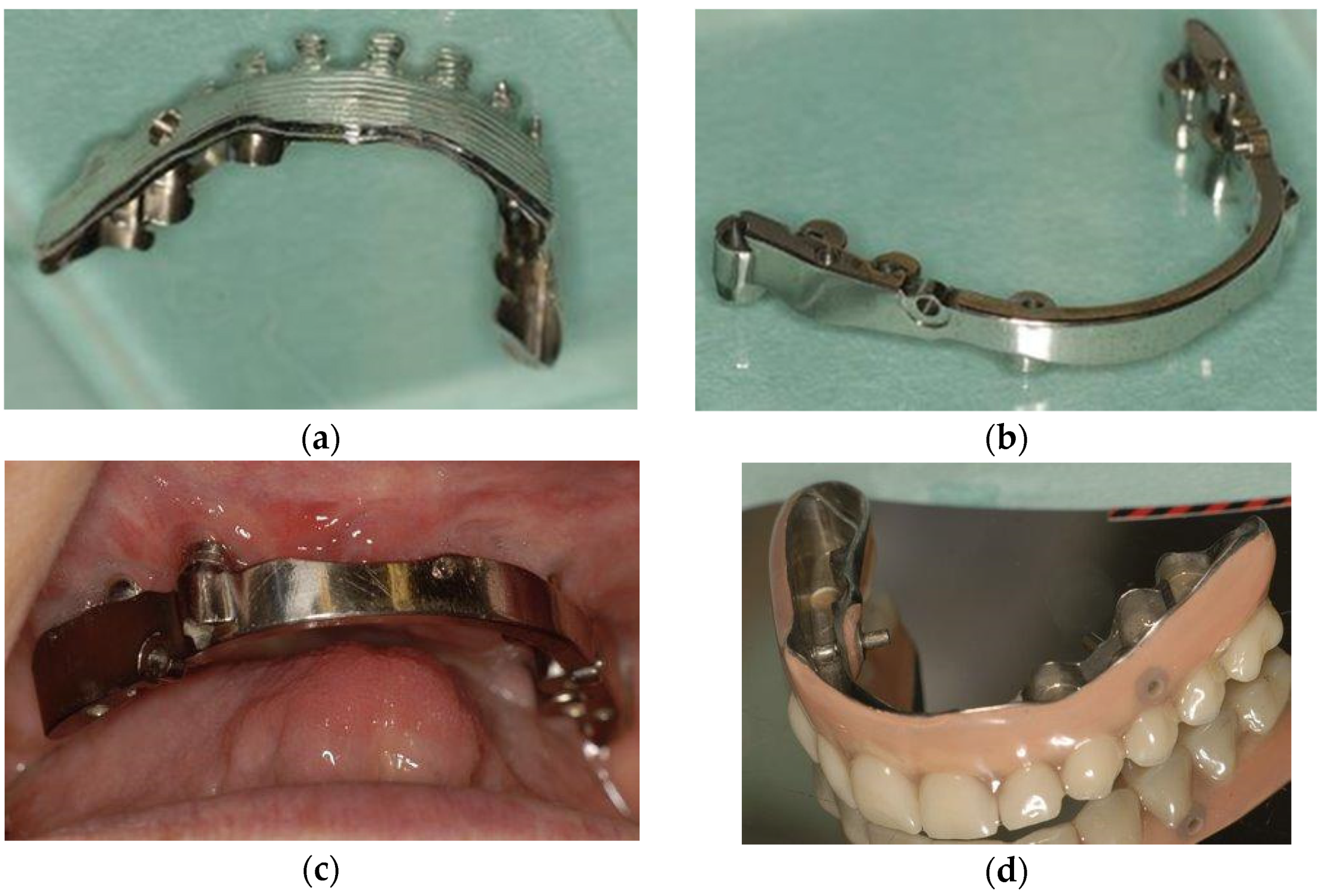Dentistry Journal | Free Full-Text | Use of Individually Designed CAD/CAM  Suprastructures for Dental Reconstruction in Patients with Cleft Lip and  Palate
