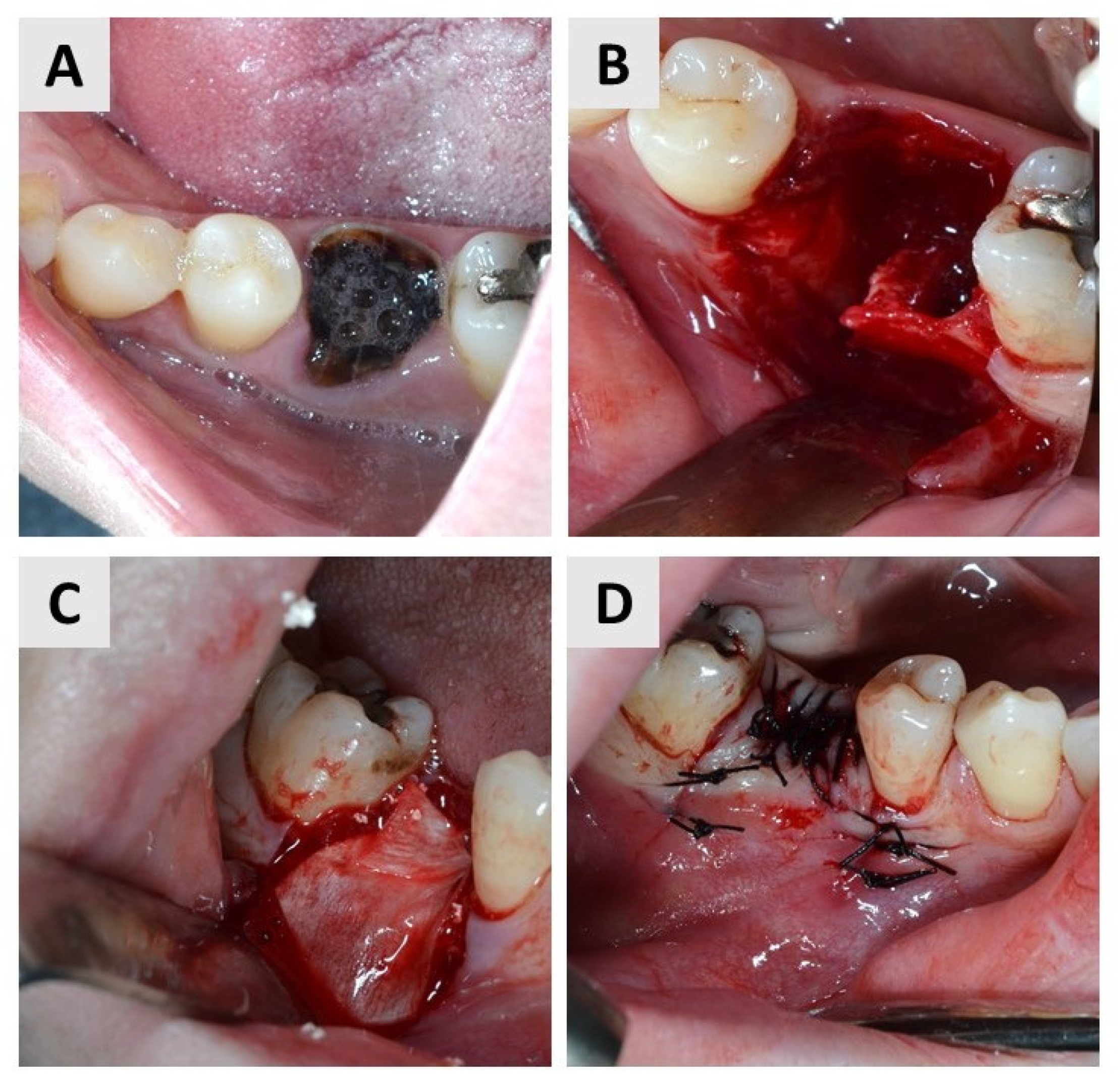 Basic Steps Involved in a Dental Filling Procedure - Fisher Pointe