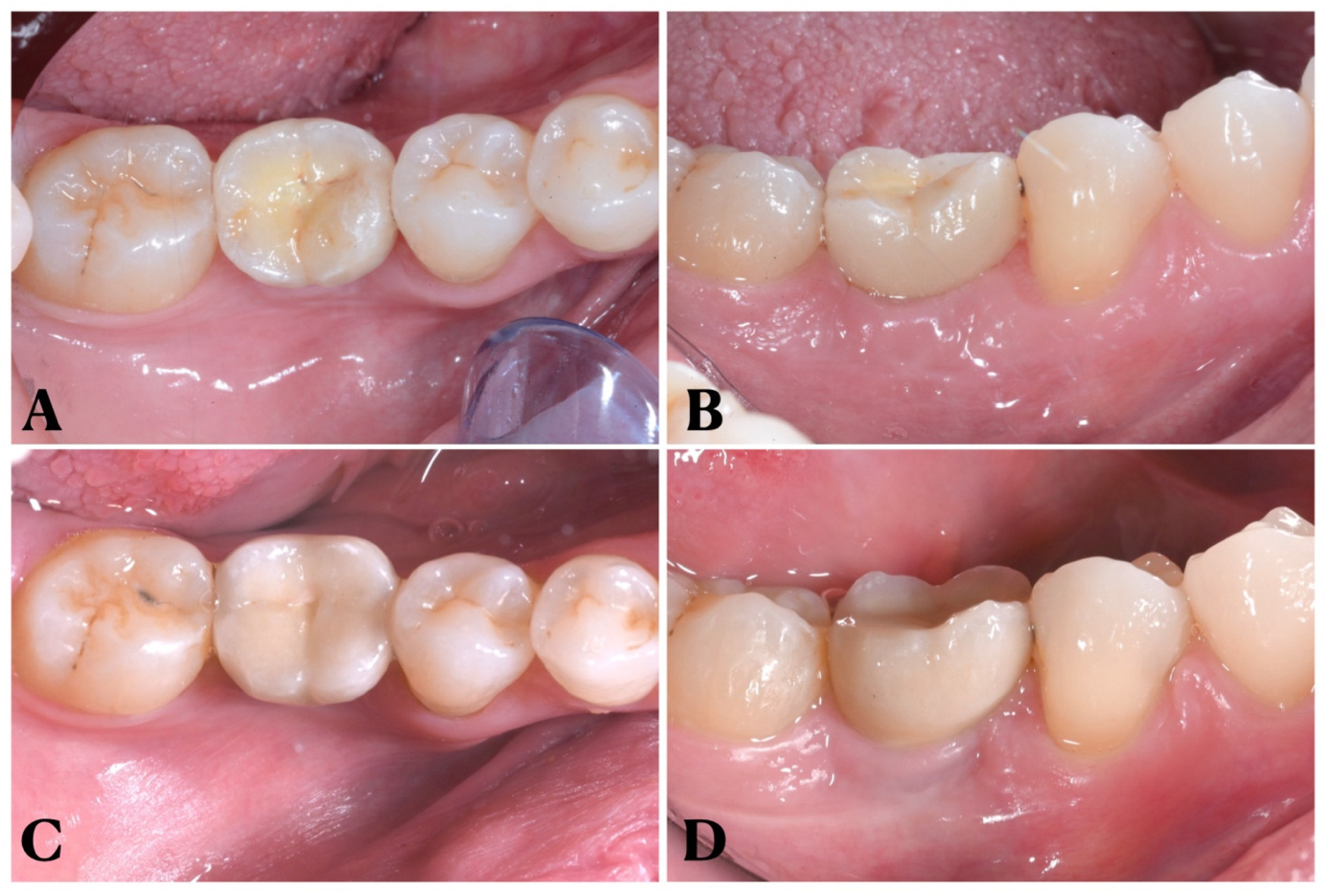 Cureus, Comparative Clinical Study Between Chlorhexidine Gel (0.2%) and  Hyaluronic Gel (1%) in the Prevention of a Dry Socket After Tooth  Extraction for Orthodontic Treatment