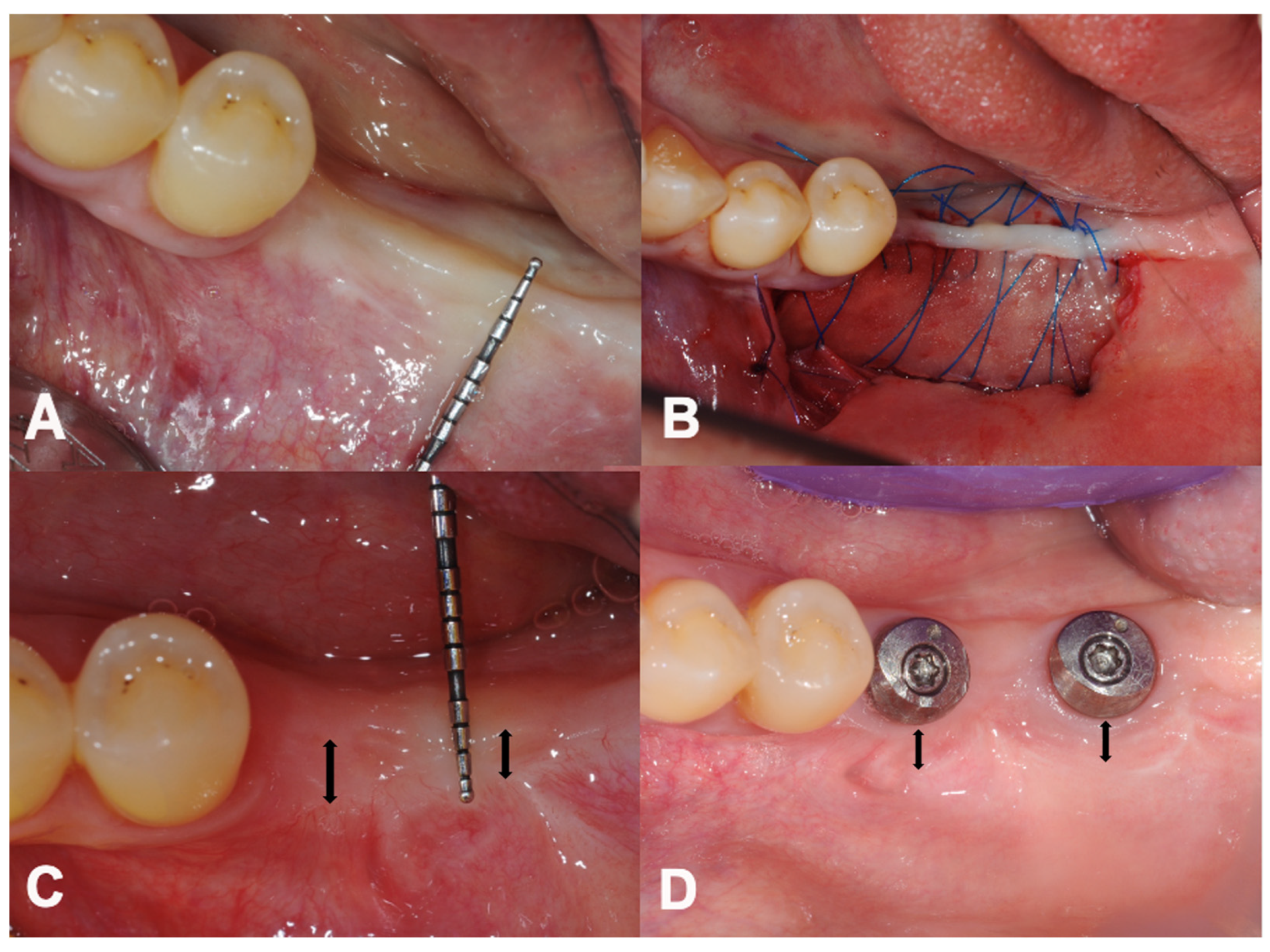 Dentistry Journal | Free Full-Text | Novel Technique to 