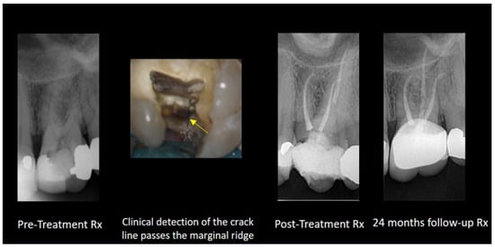 Epoxy vs. Calcium Silicate-Based Root Canal Sealers for Different ...