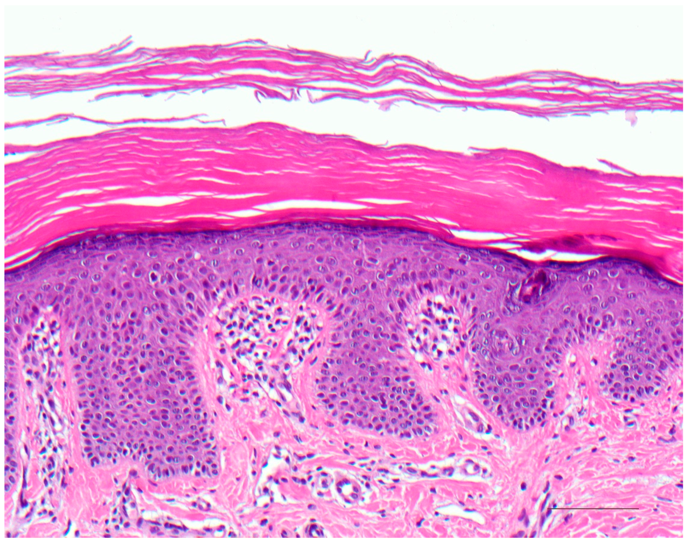 lamellar ichthyosis histology